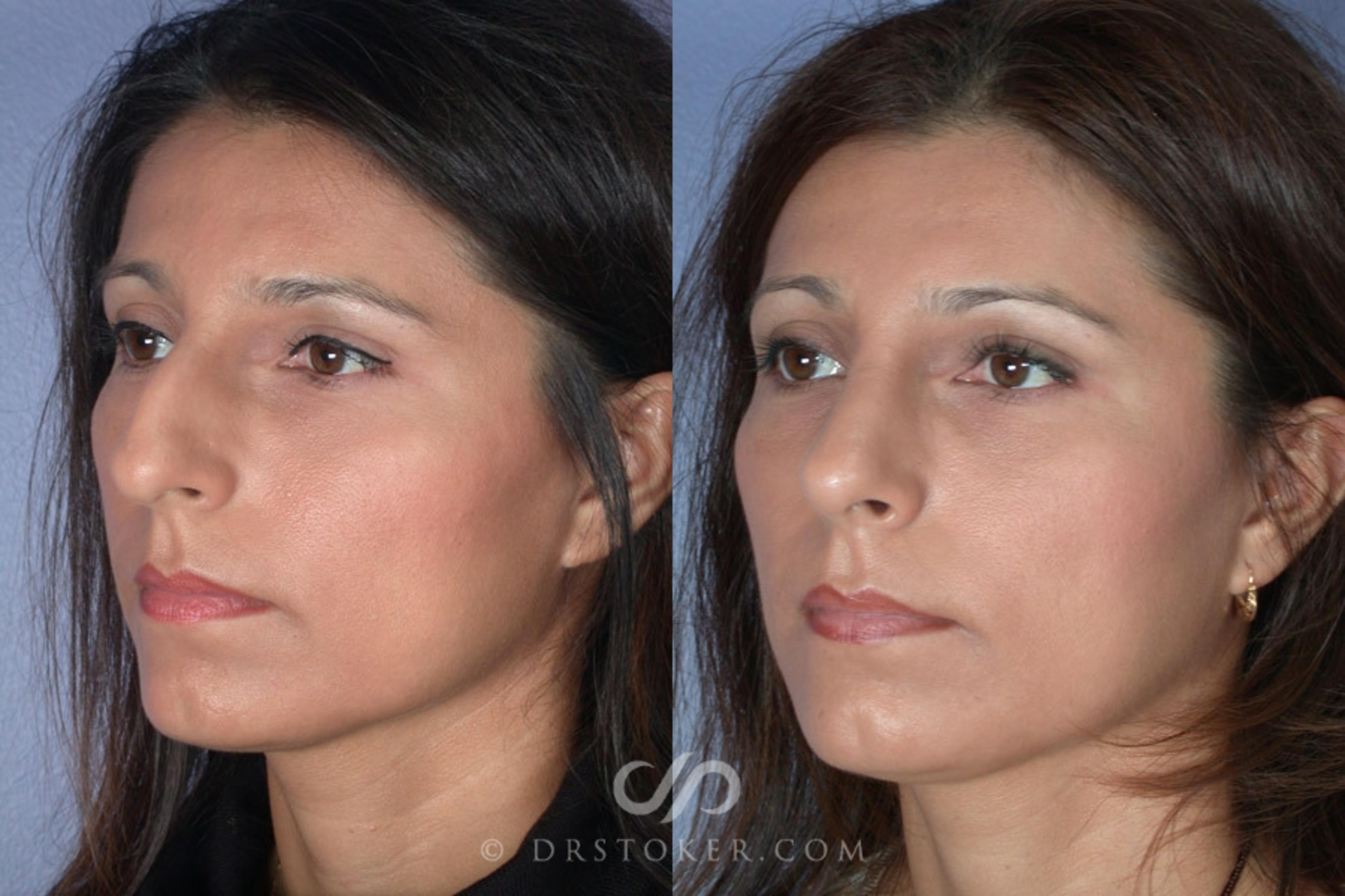 Before & After Rhinoplasty Case 2249 Left Oblique View in Los Angeles, CA