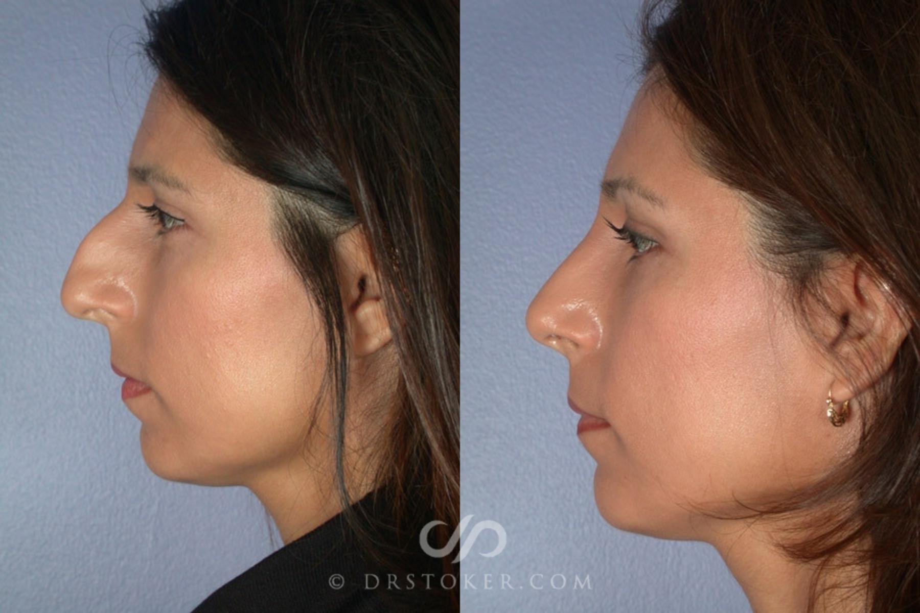 Before & After Rhinoplasty Case 2250 Left Side View in Los Angeles, CA