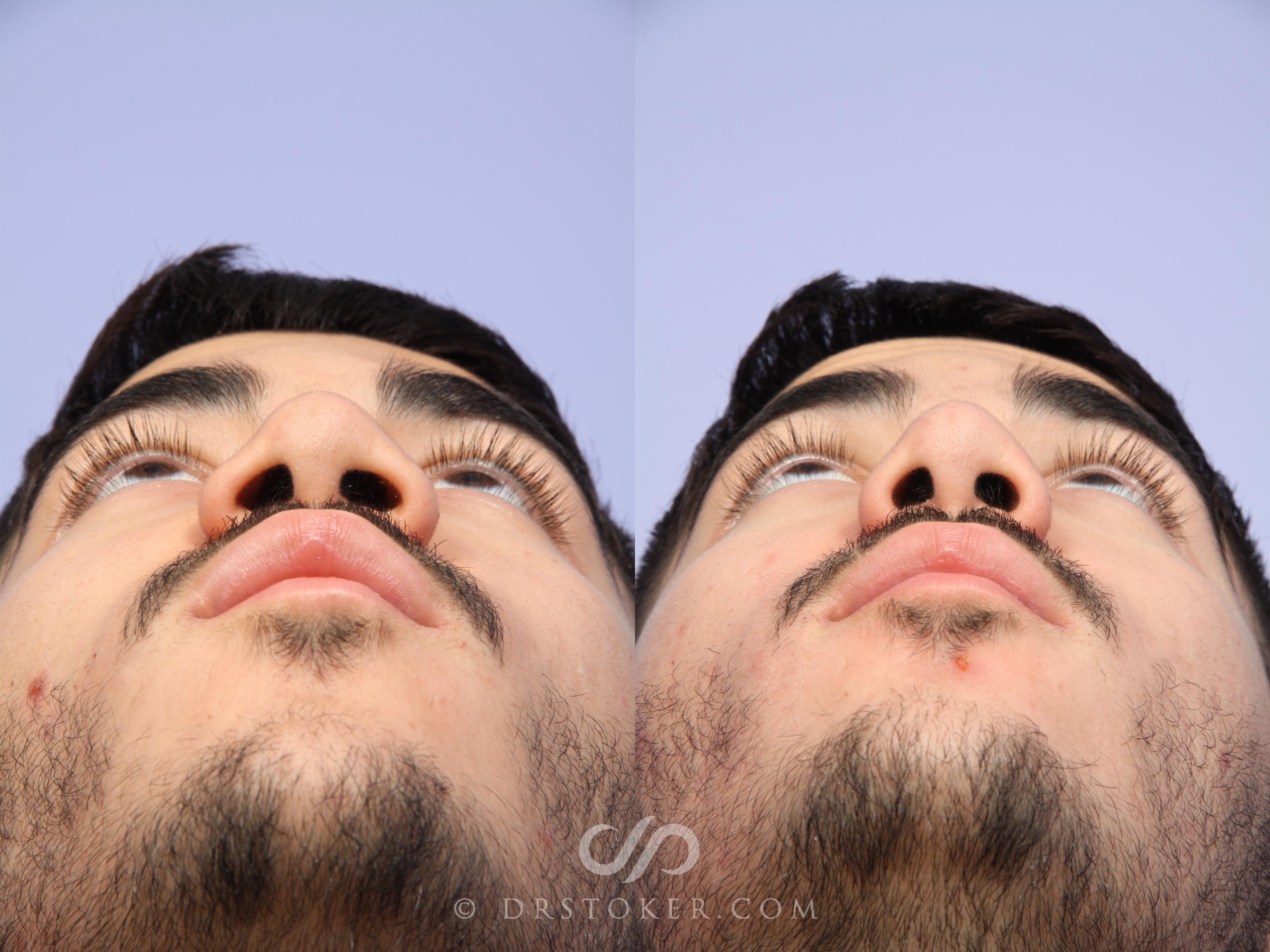 Before & After Rhinoplasty Case 2251 Under View in Los Angeles, CA