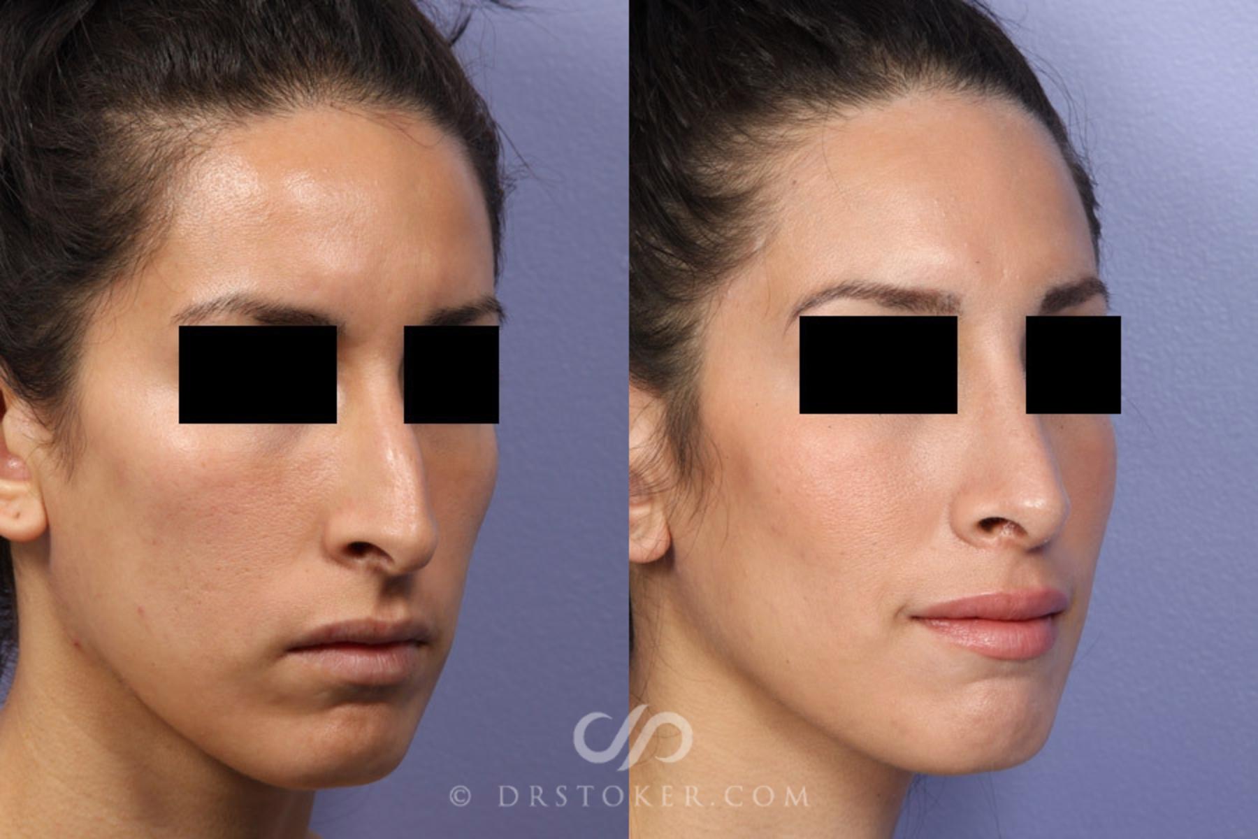 Before & After Rhinoplasty Case 2252 Right Oblique View in Los Angeles, CA