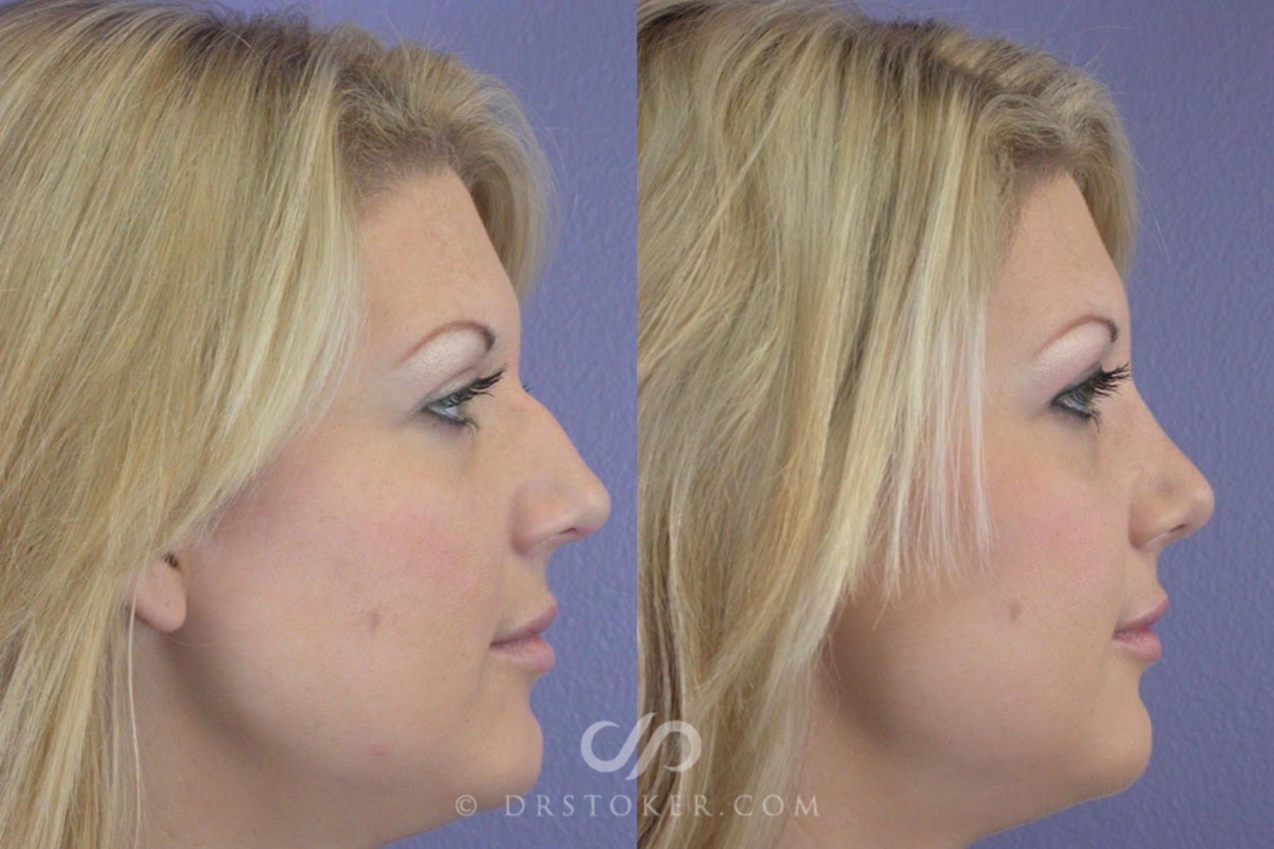 Before & After Rhinoplasty Case 2253 Right Side View in Los Angeles, CA