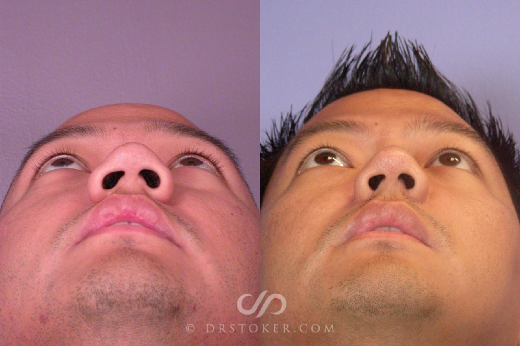 Before & After Rhinoplasty Case 2254 Under View in Los Angeles, CA