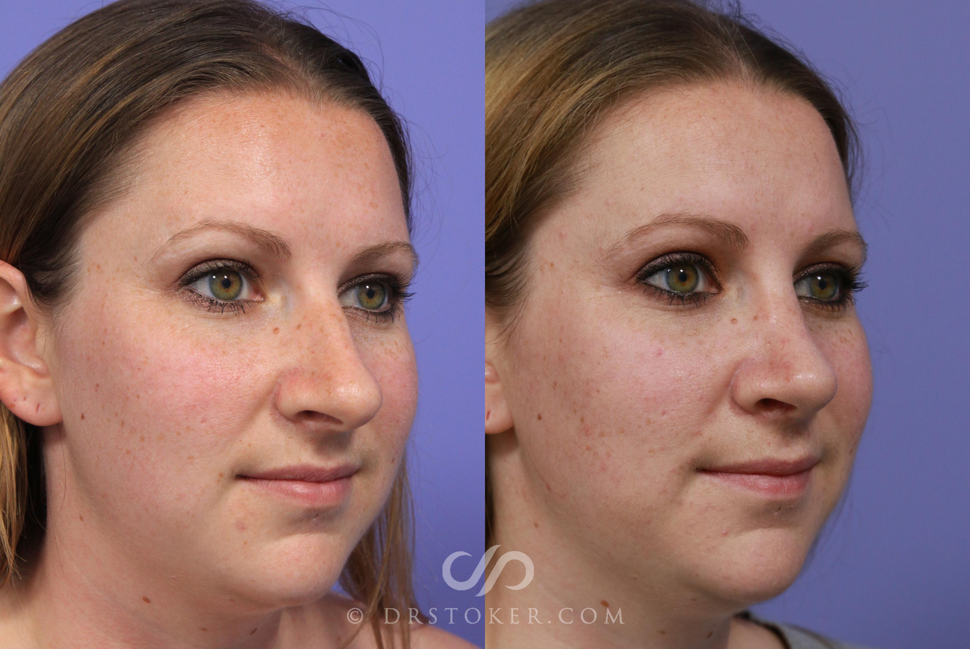 Before & After Rhinoplasty Case 2255 Right Oblique View in Los Angeles, CA