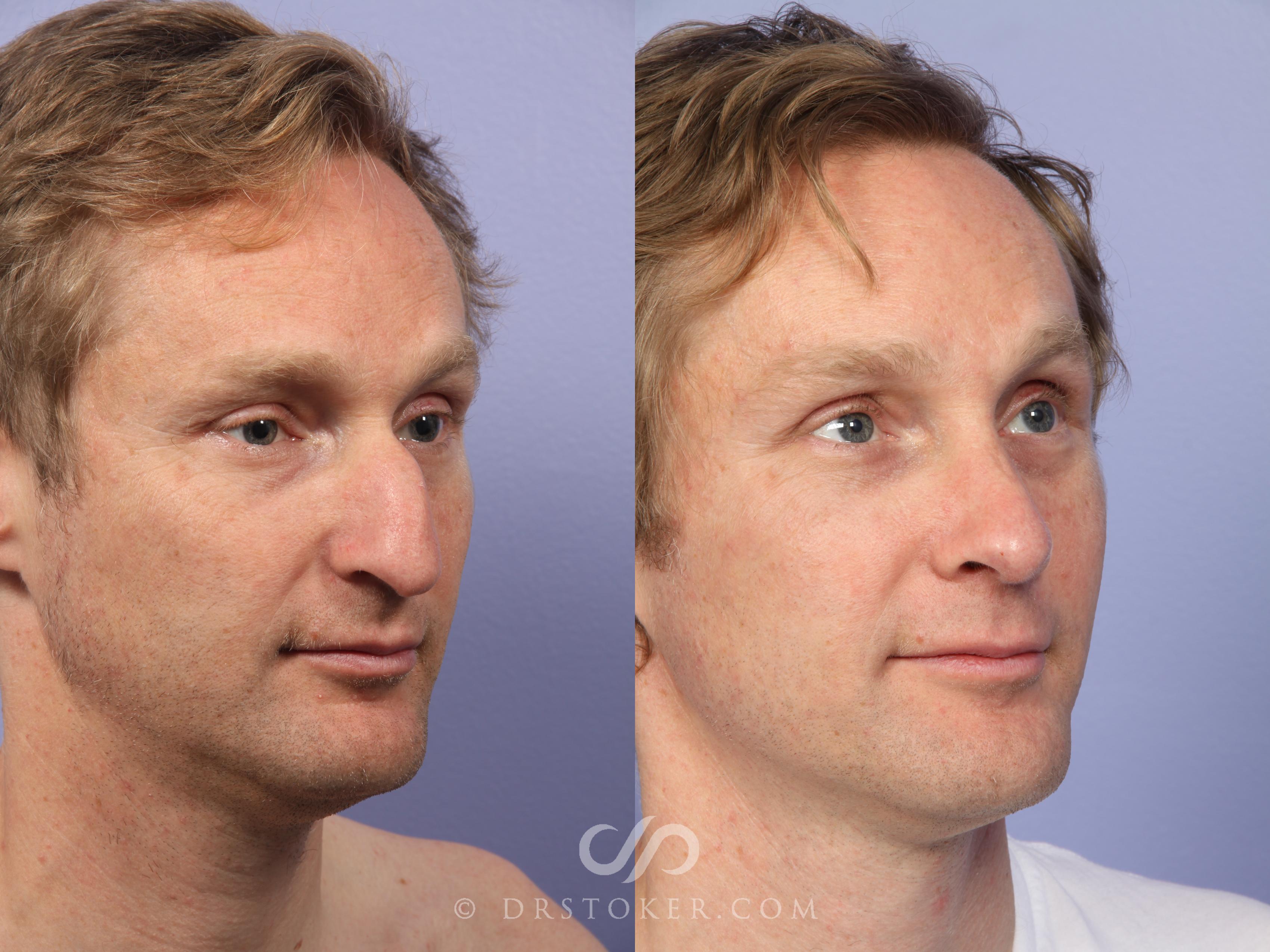 Before & After Rhinoplasty Case 2256 Right Oblique View in Los Angeles, CA