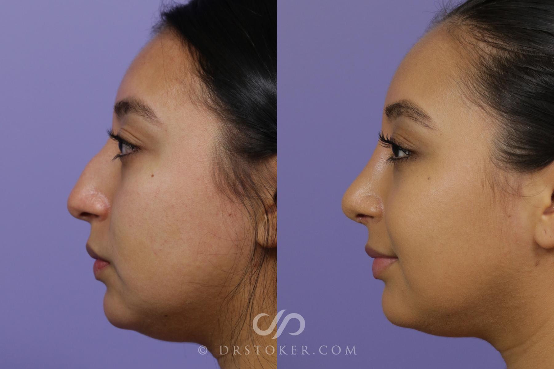 Before & After Rhinoplasty Case 2323 Left Side View in Los Angeles, CA