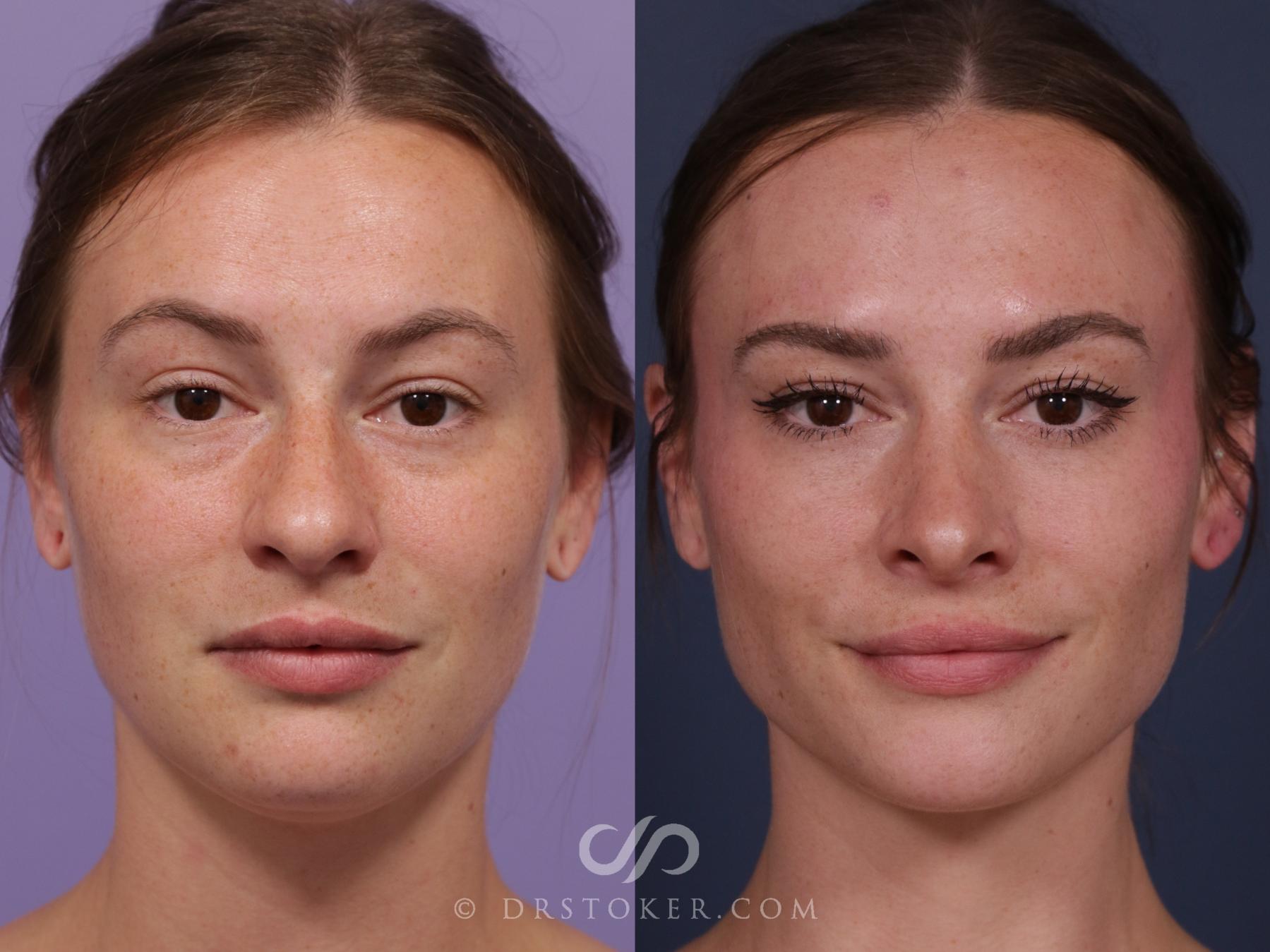 Before & After Rhinoplasty Case 2326 Front View in Los Angeles, CA