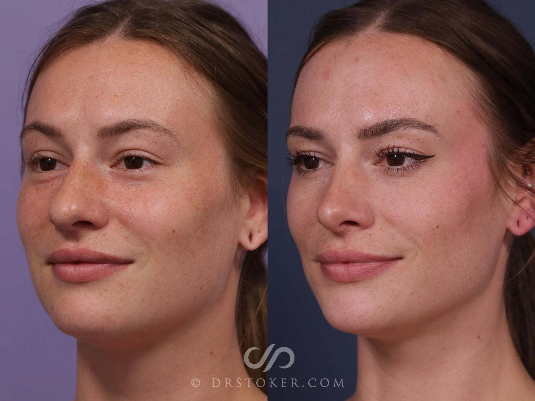 Before & After Rhinoplasty Case 2326 Left Oblique View in Los Angeles, CA