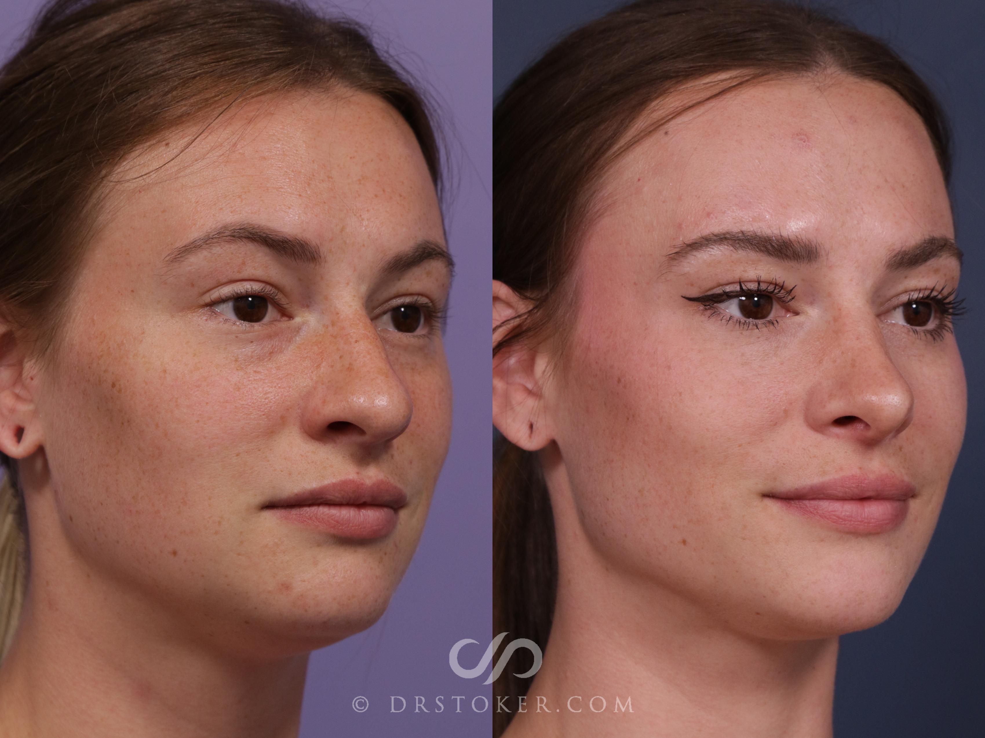 Before & After Rhinoplasty Case 2326 Right Oblique View in Los Angeles, CA