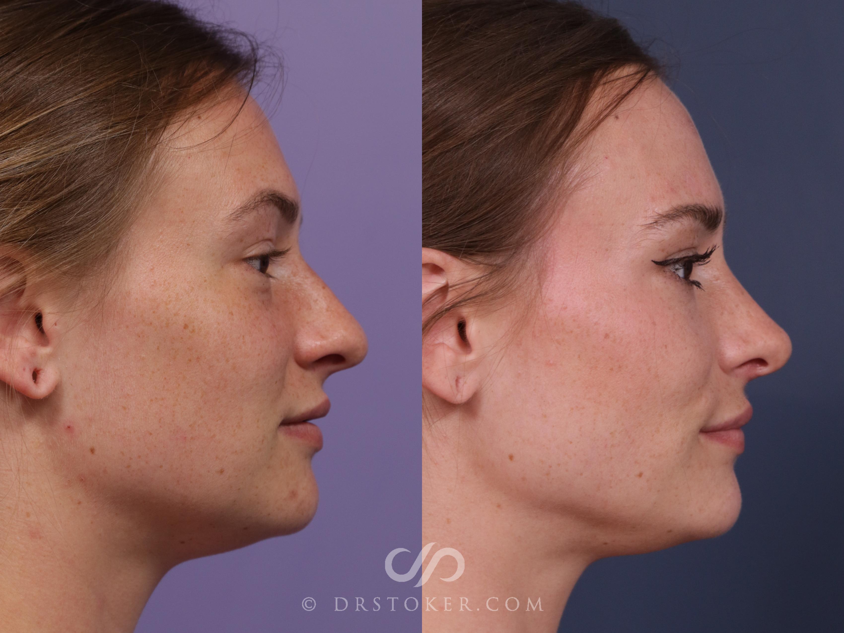 Before & After Rhinoplasty Case 2326 Right Side View in Los Angeles, CA