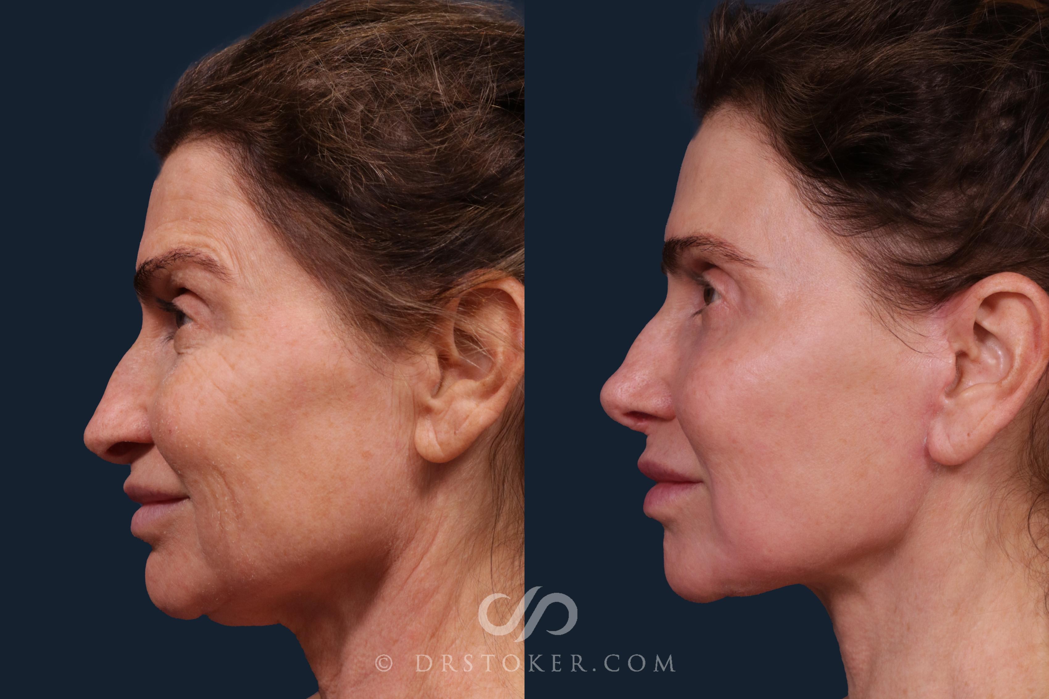 Before & After Rhinoplasty Case 2332 Left Side View in Los Angeles, CA