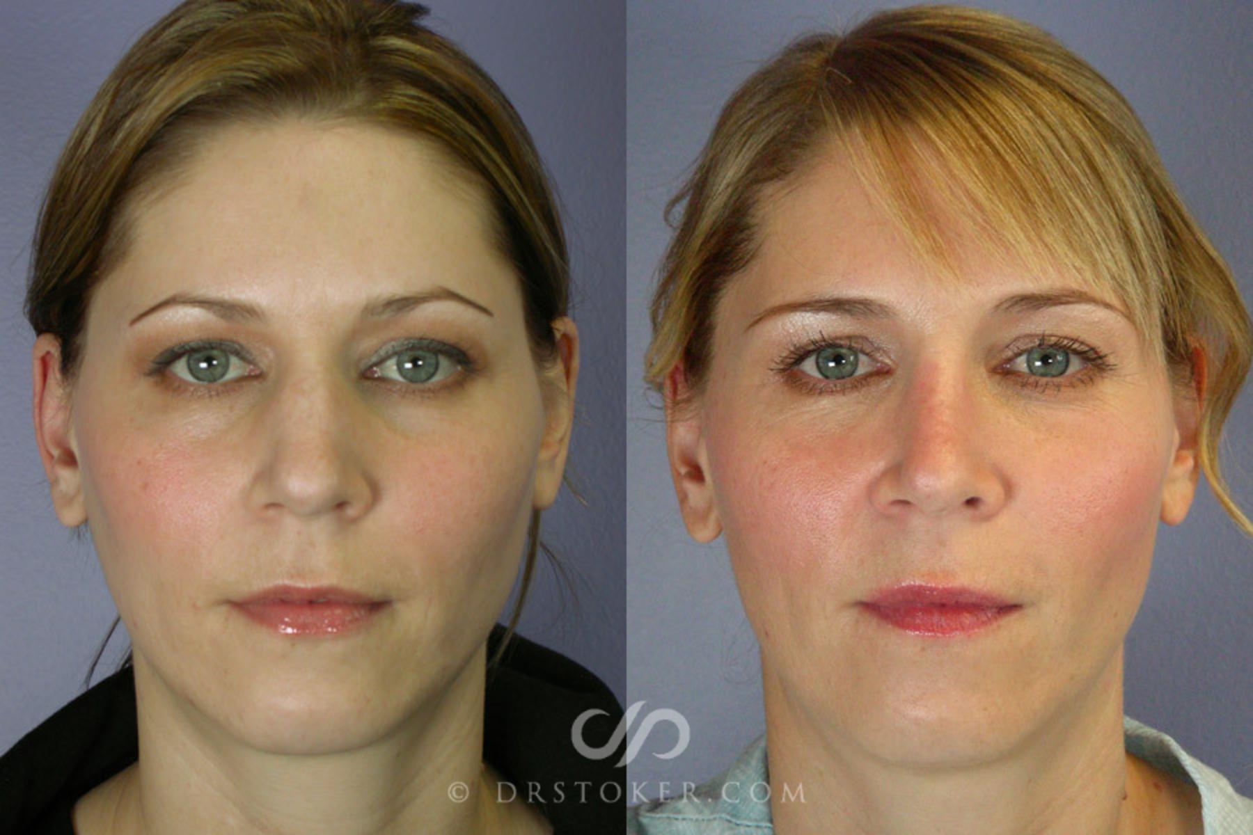 Before & After Rhinoplasty Case 265 View #1 View in Los Angeles, CA