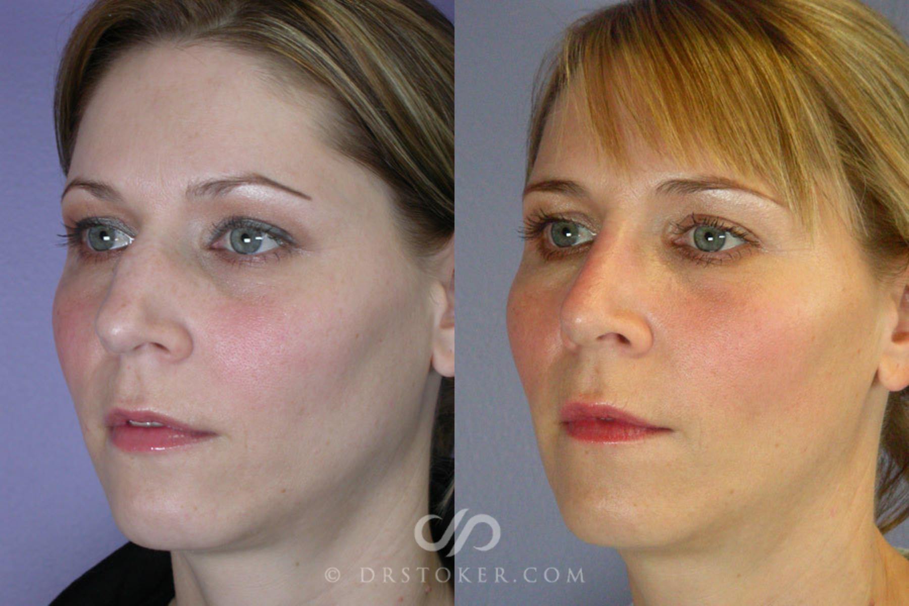 Before & After Rhinoplasty Case 265 View #3 View in Los Angeles, CA