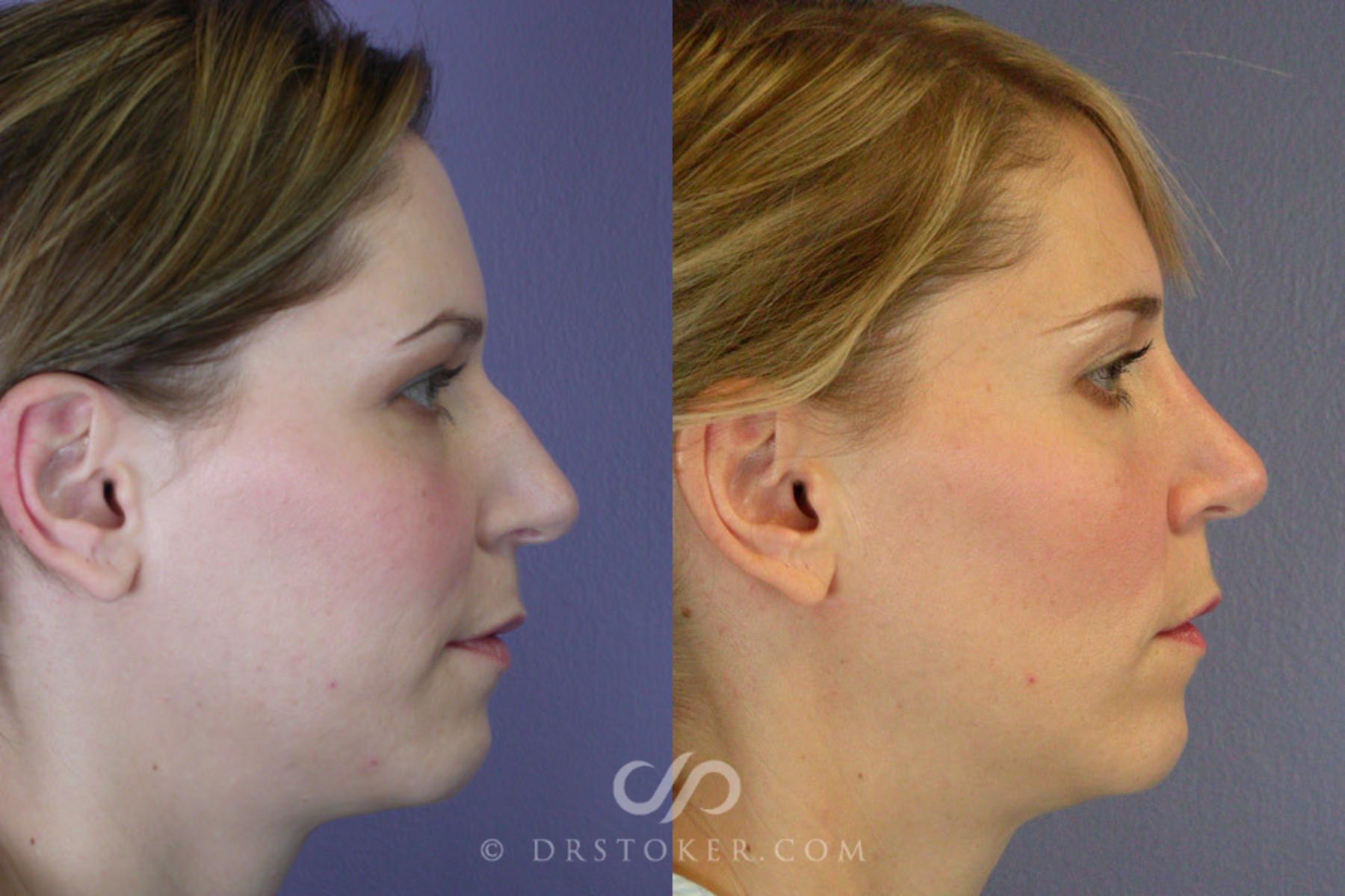 Before & After Rhinoplasty Case 265 View #4 View in Los Angeles, CA