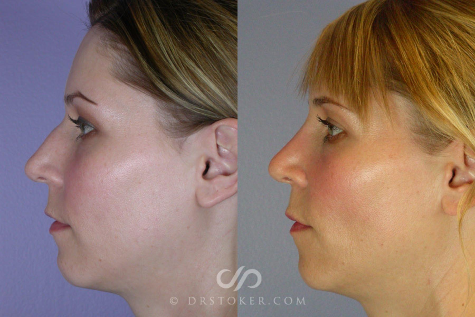 Before & After Rhinoplasty Case 265 View #5 View in Los Angeles, CA