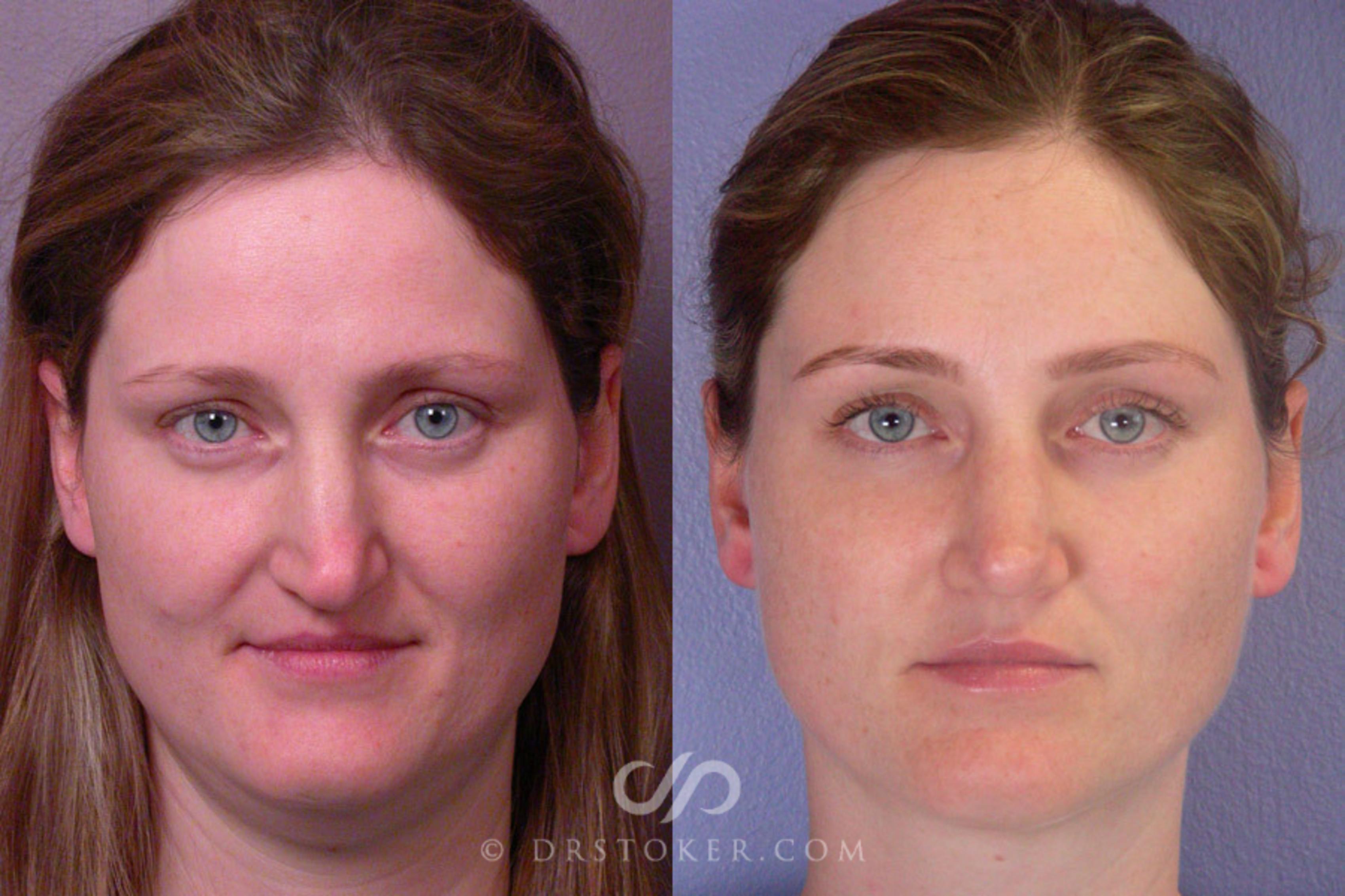 Before & After Rhinoplasty Case 267 View #1 View in Los Angeles, CA