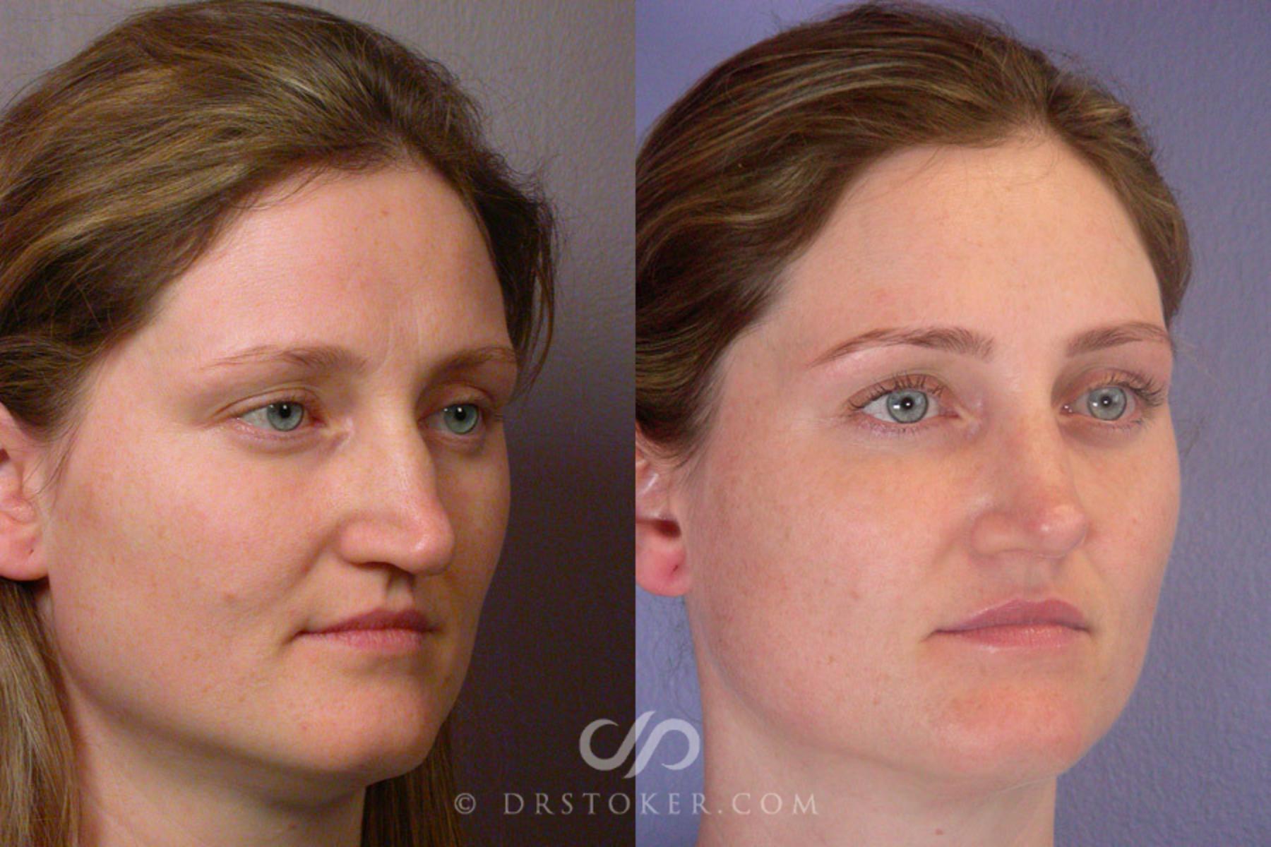 Before & After Rhinoplasty Case 267 View #2 View in Los Angeles, CA