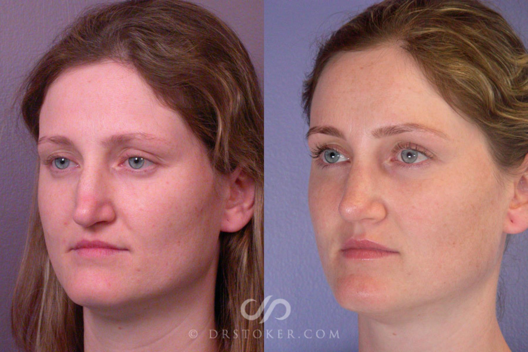 Before & After Rhinoplasty Case 267 View #3 View in Los Angeles, CA