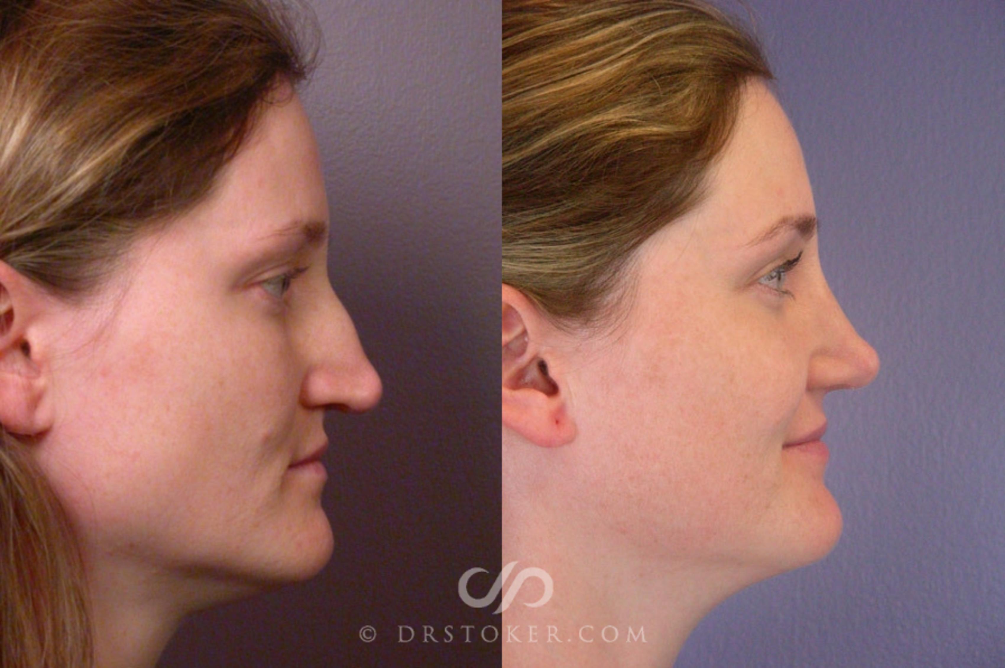 Before & After Rhinoplasty Case 267 View #4 View in Los Angeles, CA