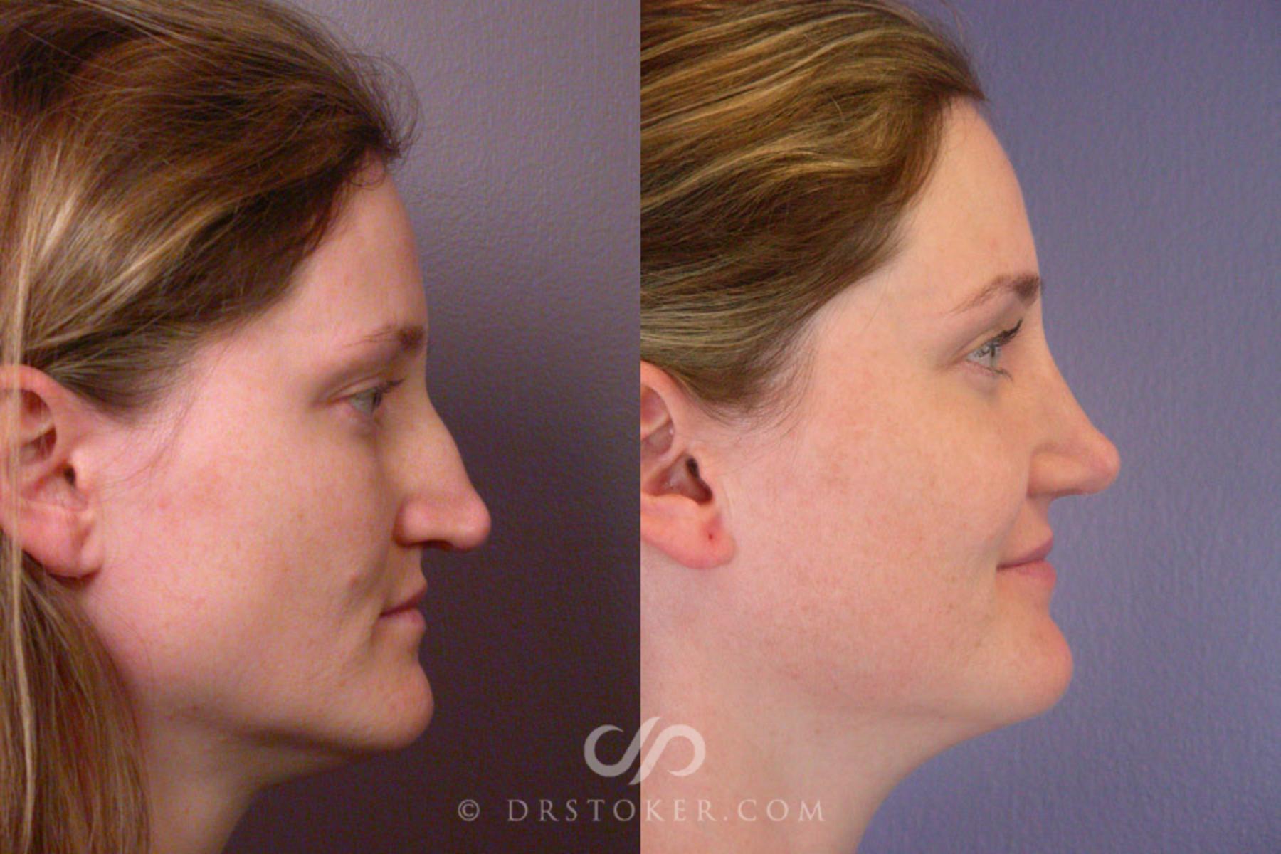 Before & After Rhinoplasty Case 267 View #4 View in Los Angeles, CA