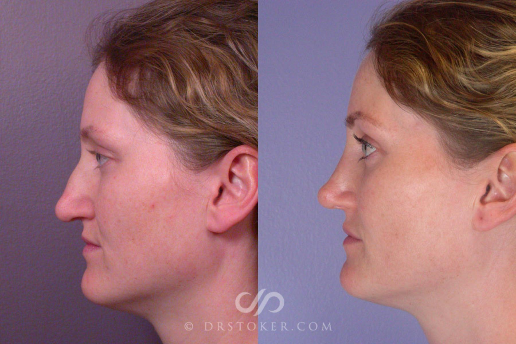 Before & After Rhinoplasty Case 267 View #5 View in Los Angeles, CA