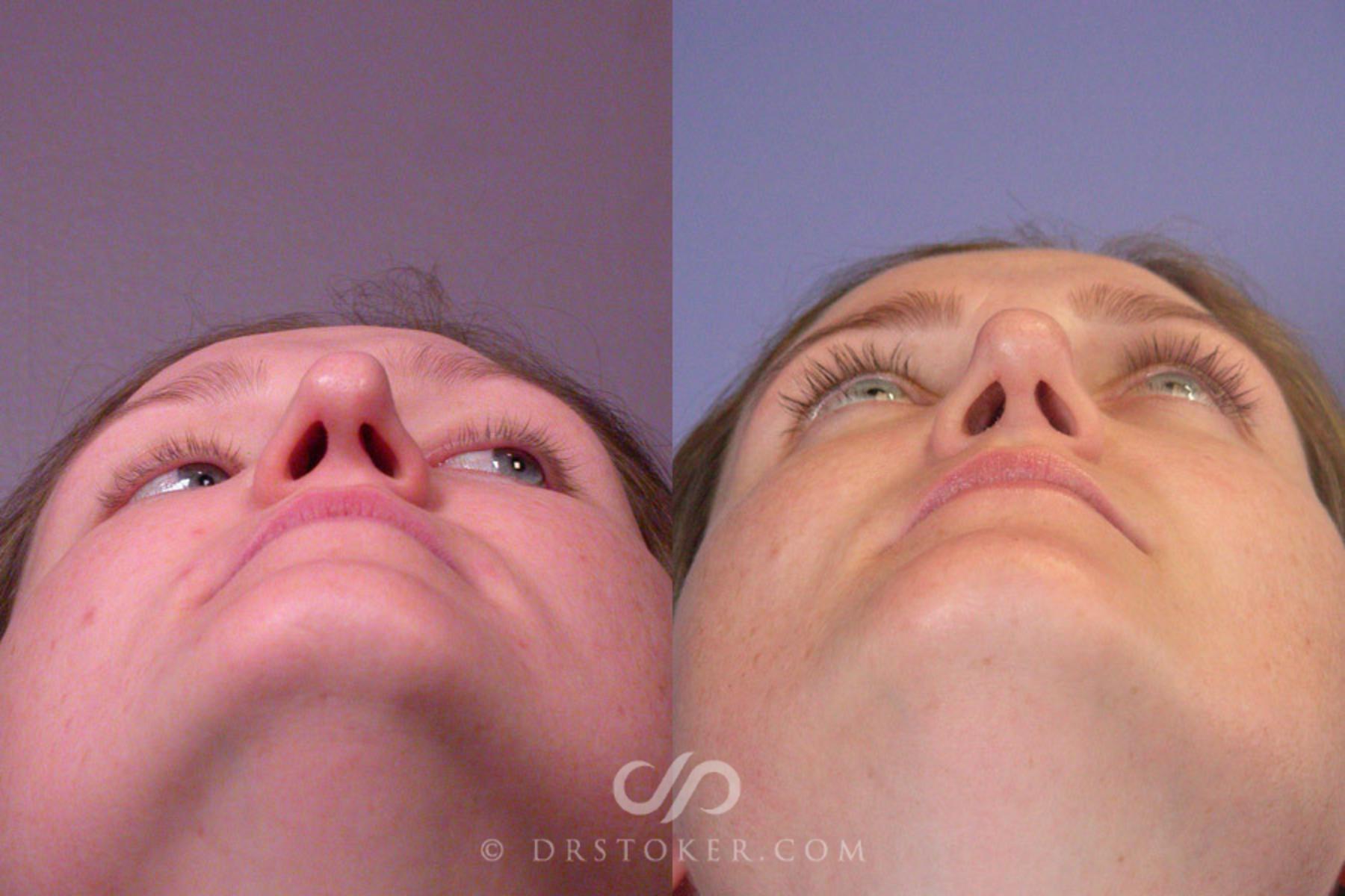 Before & After Rhinoplasty Case 267 View #6 View in Los Angeles, CA