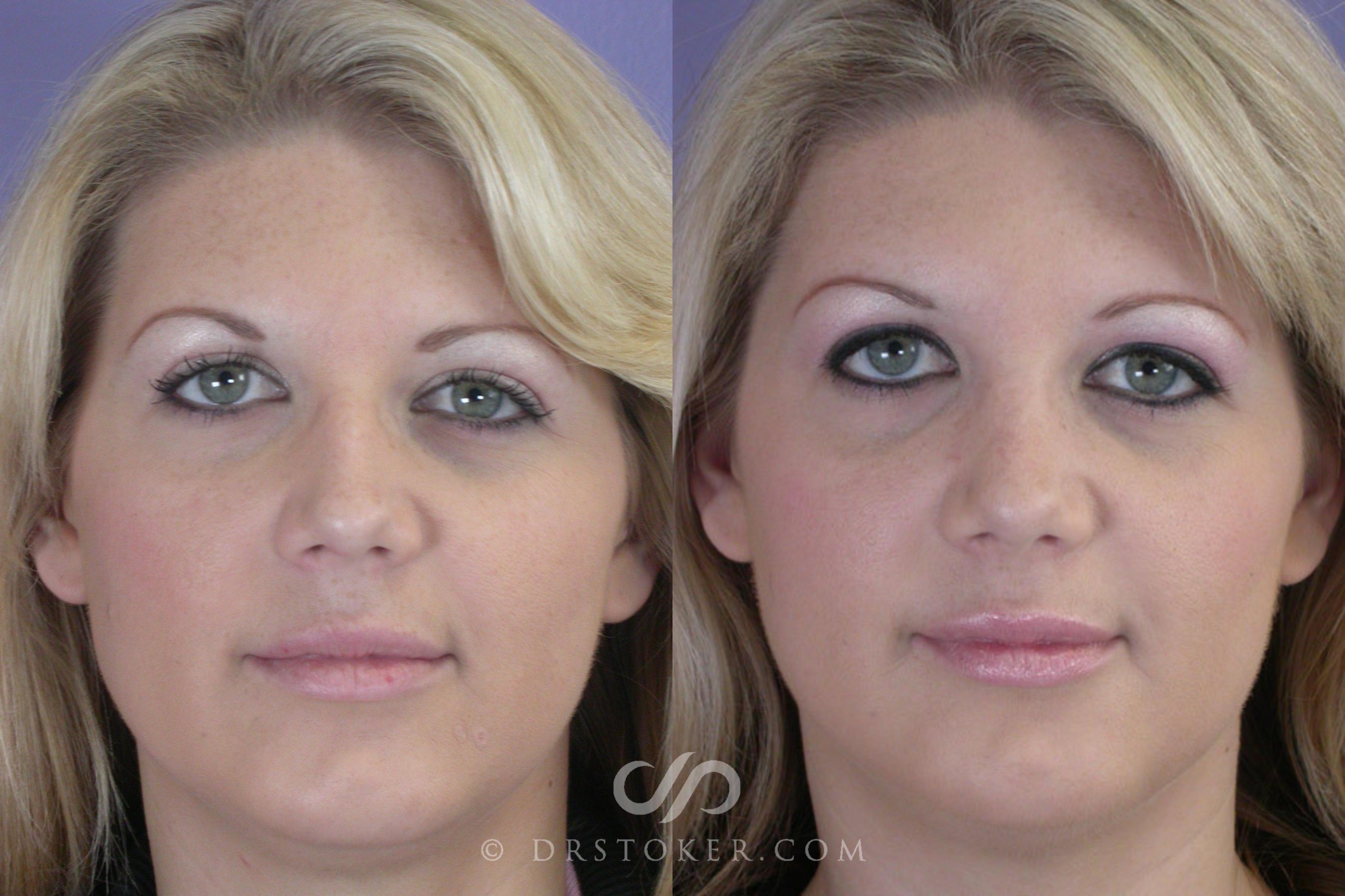 Before & After Rhinoplasty Case 268 View #1 View in Los Angeles, CA