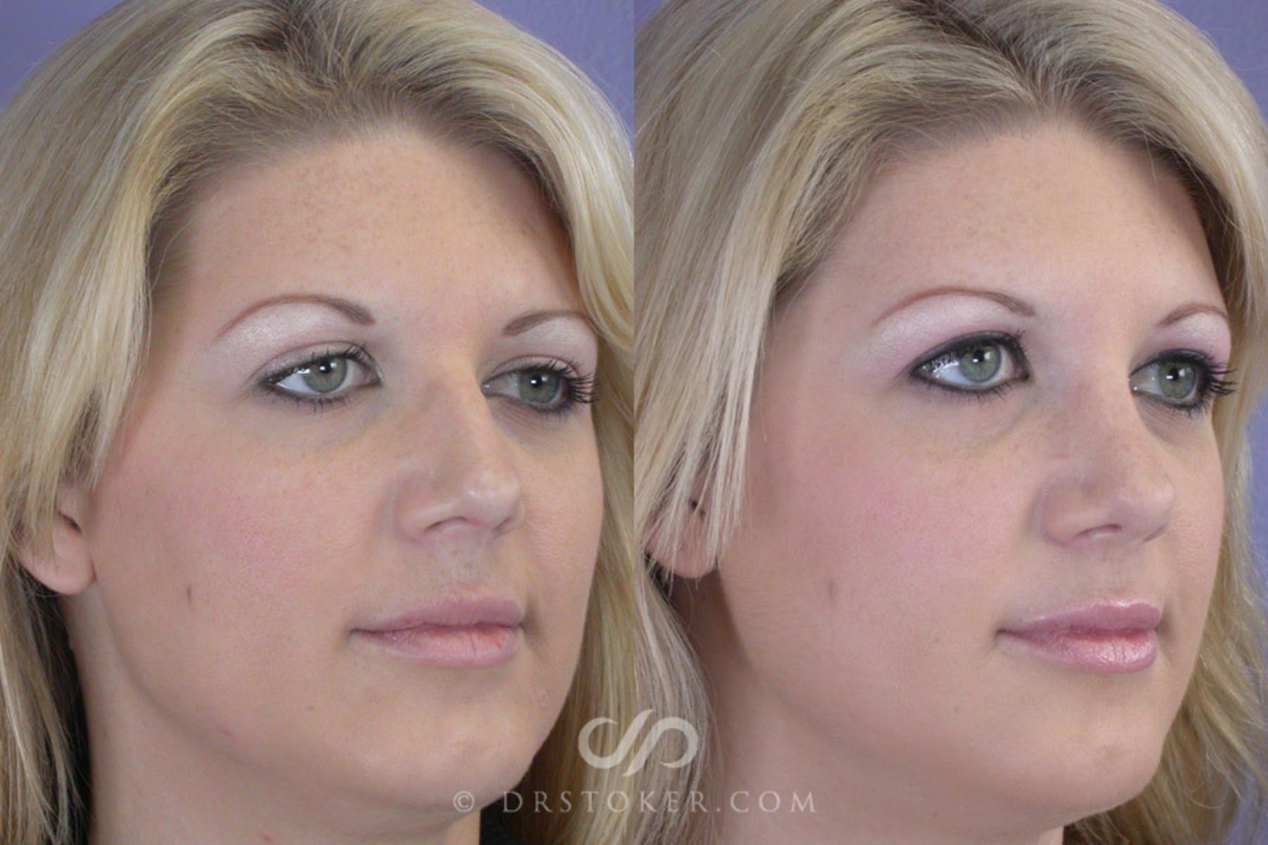 Before & After Rhinoplasty Case 268 View #2 View in Los Angeles, CA