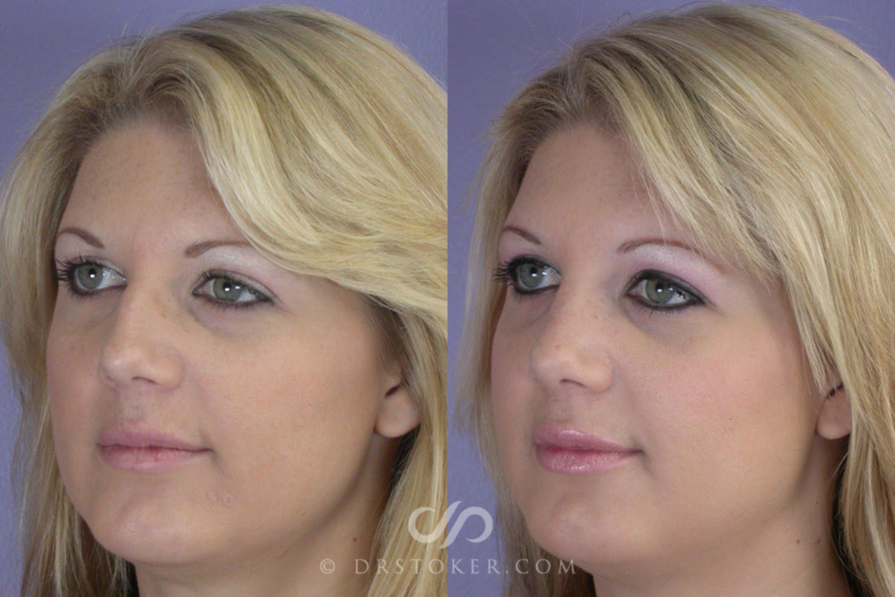 Before & After Rhinoplasty Case 268 View #3 View in Los Angeles, CA