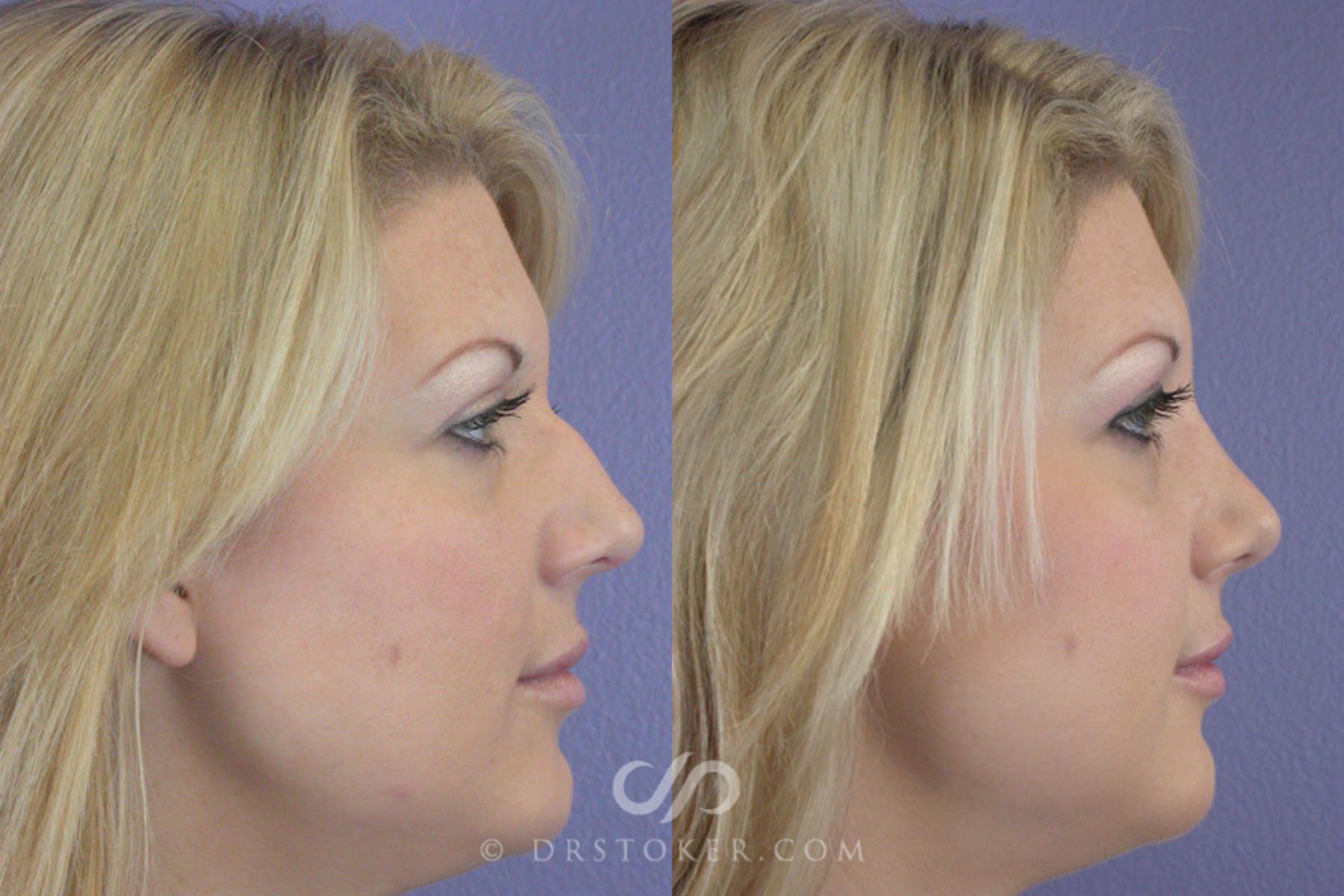 Before & After Rhinoplasty Case 268 View #4 View in Los Angeles, CA