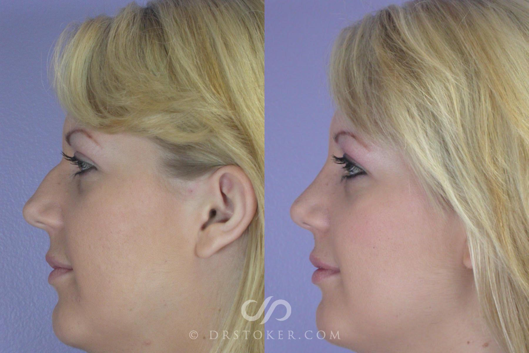 Before & After Rhinoplasty Case 268 View #5 View in Los Angeles, CA