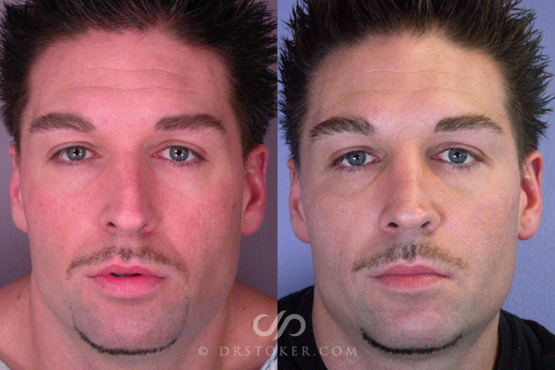 Before & After Rhinoplasty Case 269 View #1 View in Los Angeles, CA