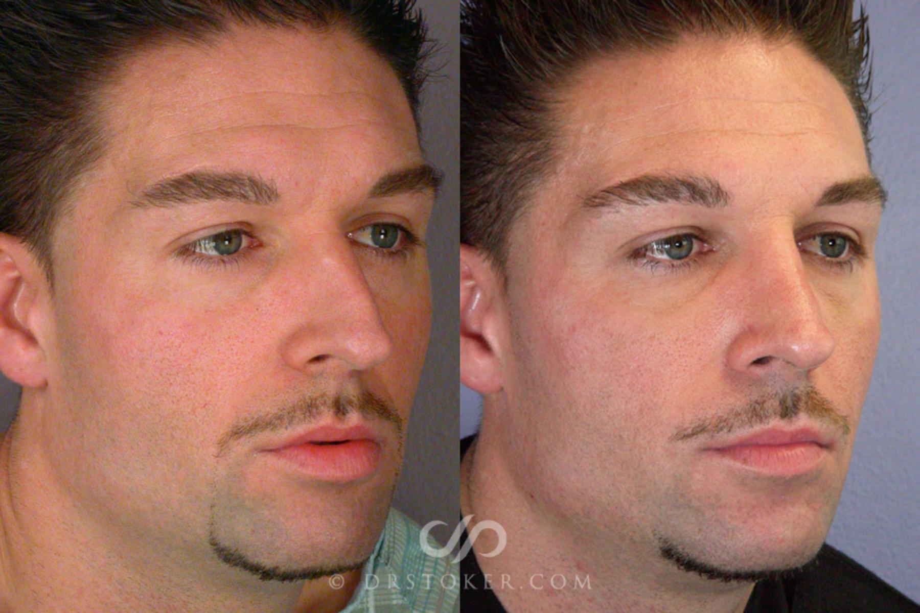 Before & After Rhinoplasty Case 269 View #2 View in Los Angeles, CA