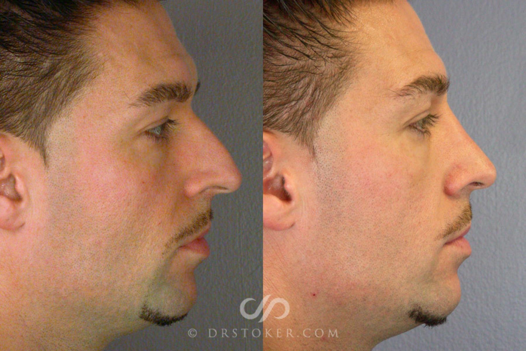 Before & After Rhinoplasty Case 269 View #3 View in Los Angeles, CA