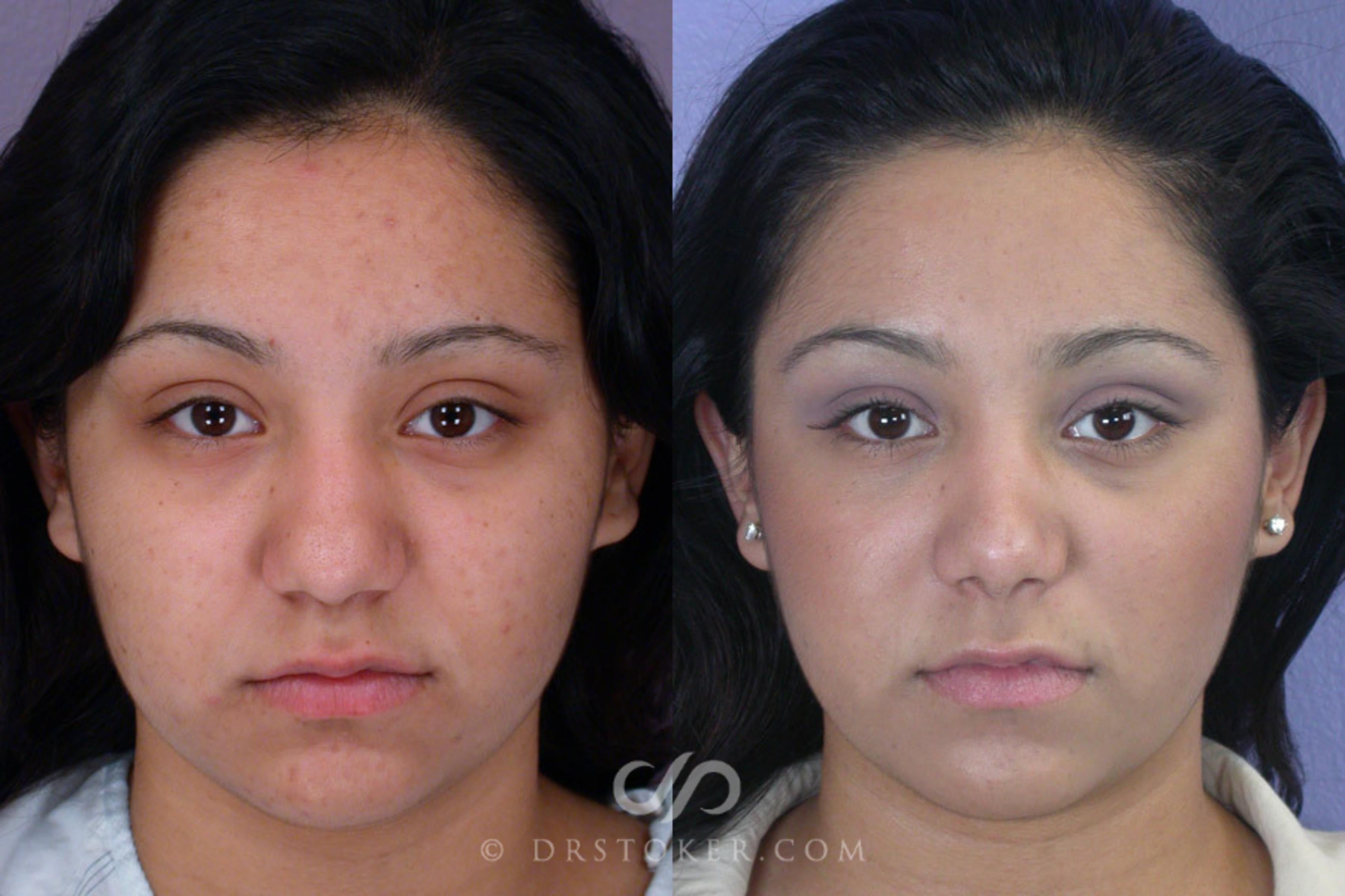 Before & After Rhinoplasty Case 271 View #1 View in Los Angeles, CA