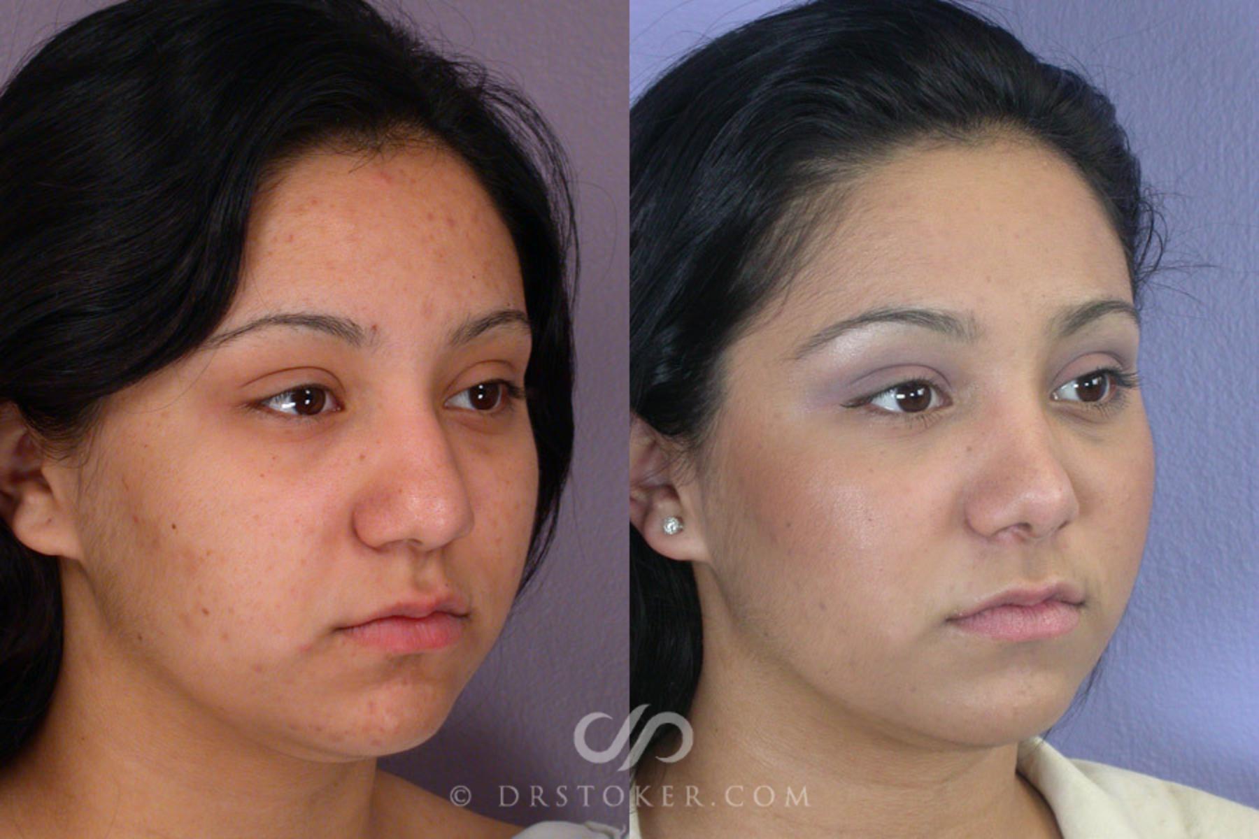 Before & After Rhinoplasty Case 271 View #2 View in Los Angeles, CA