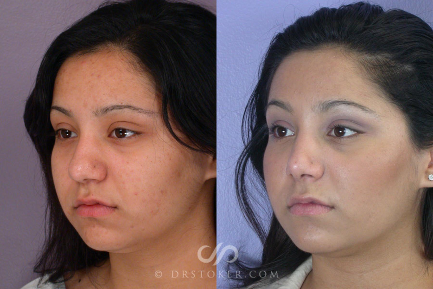 Before & After Rhinoplasty Case 271 View #3 View in Los Angeles, CA