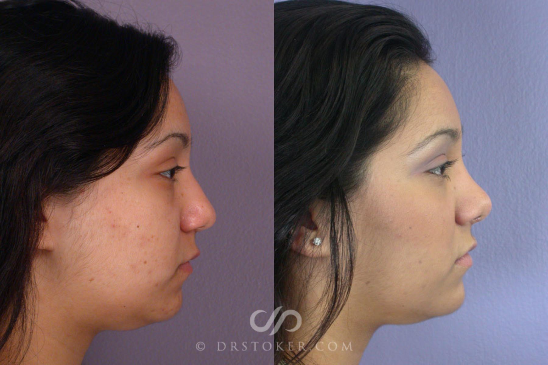 Before & After Rhinoplasty Case 271 View #4 View in Los Angeles, CA