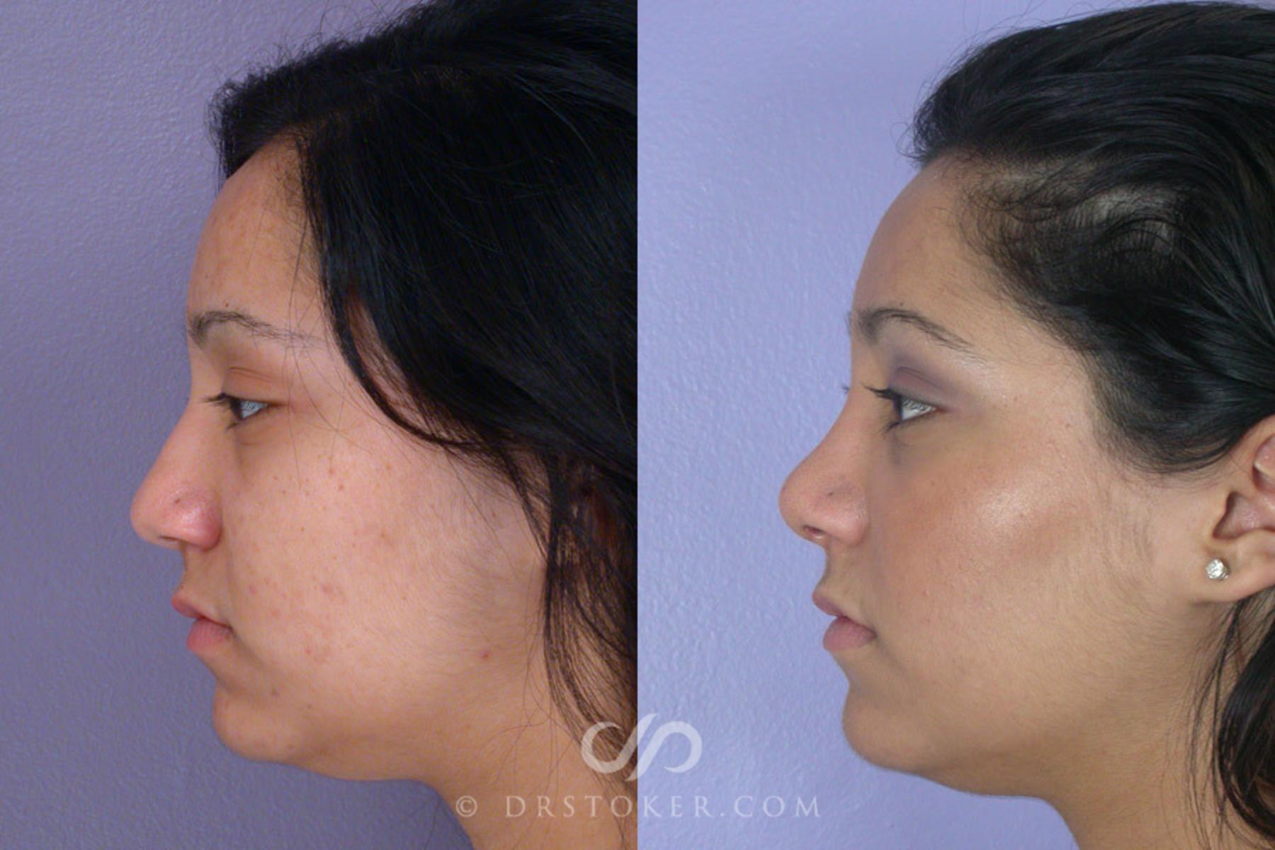 Before & After Rhinoplasty Case 271 View #5 View in Los Angeles, CA