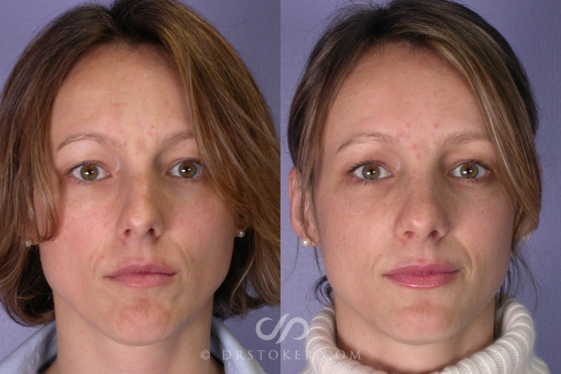 Before & After Rhinoplasty Case 272 View #1 View in Los Angeles, CA