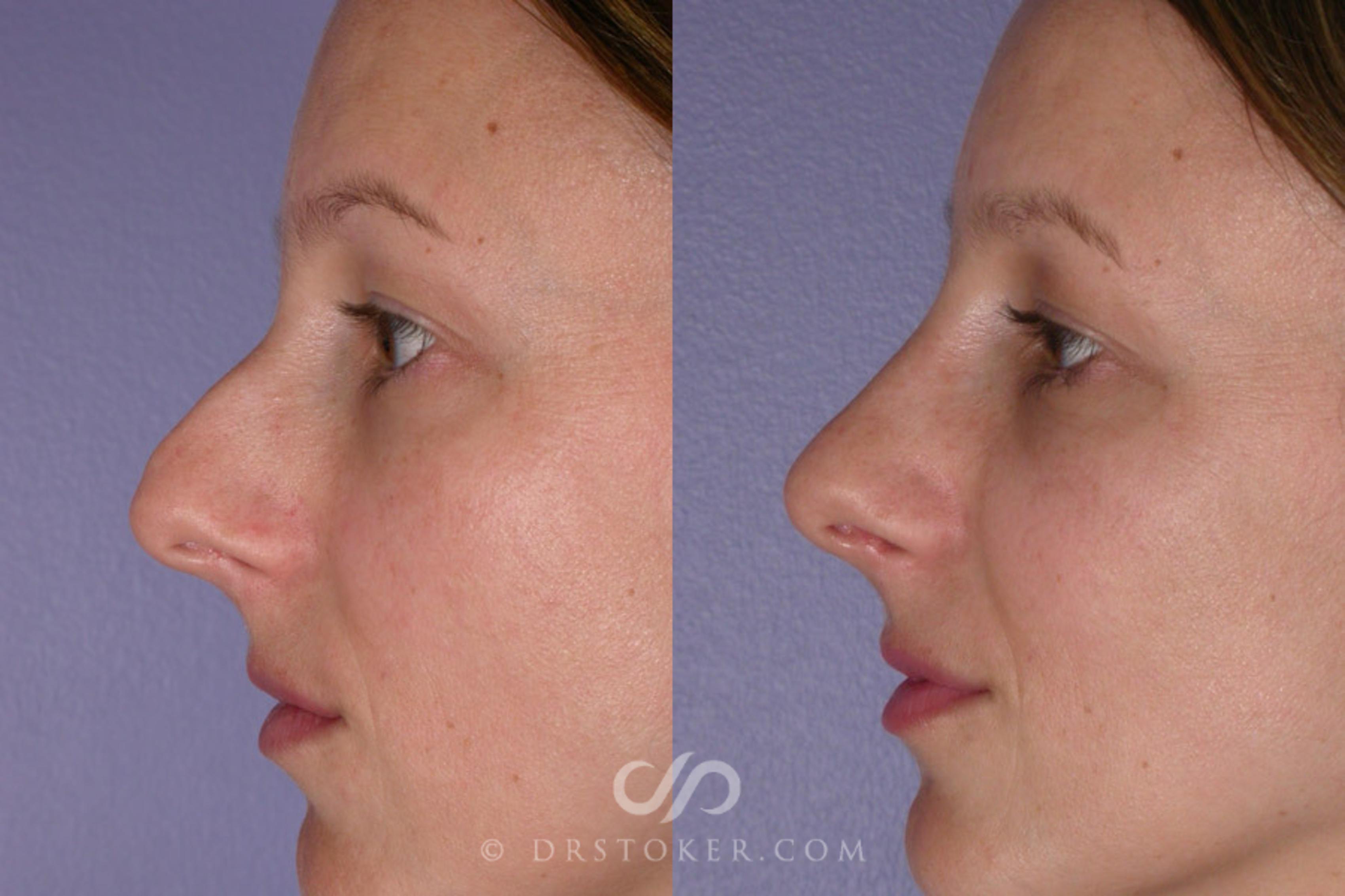 Before & After Rhinoplasty Case 272 View #2 View in Los Angeles, CA