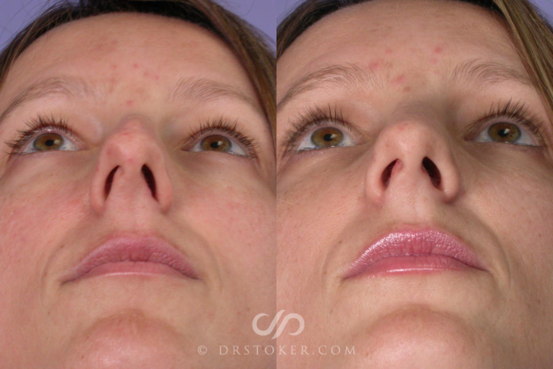 Before & After Rhinoplasty Case 272 View #3 View in Los Angeles, CA