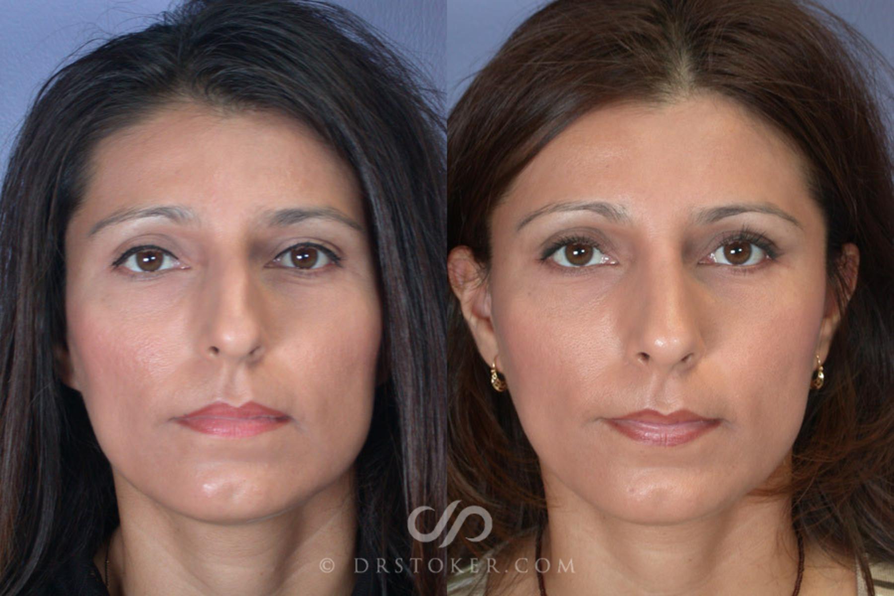 Before & After Rhinoplasty Case 273 View #1 View in Los Angeles, CA