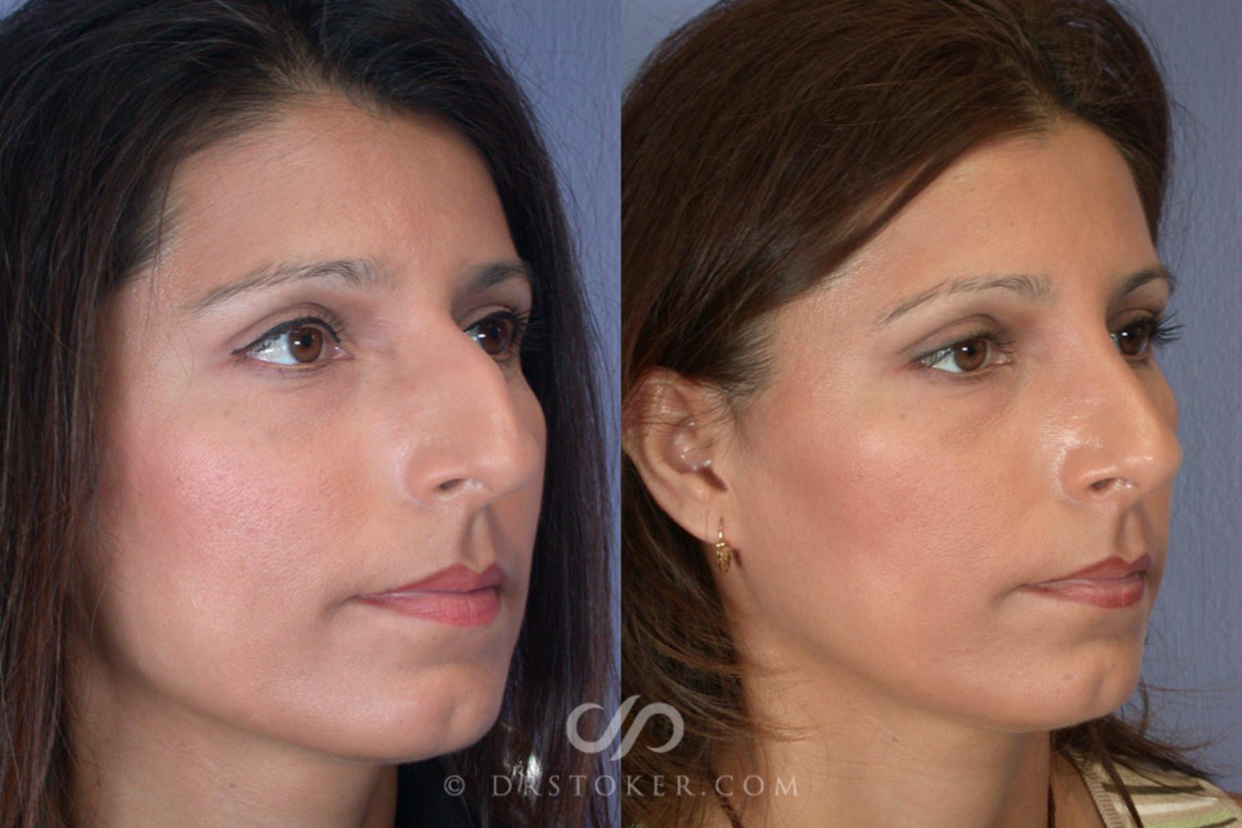 Before & After Rhinoplasty Case 273 View #2 View in Los Angeles, CA