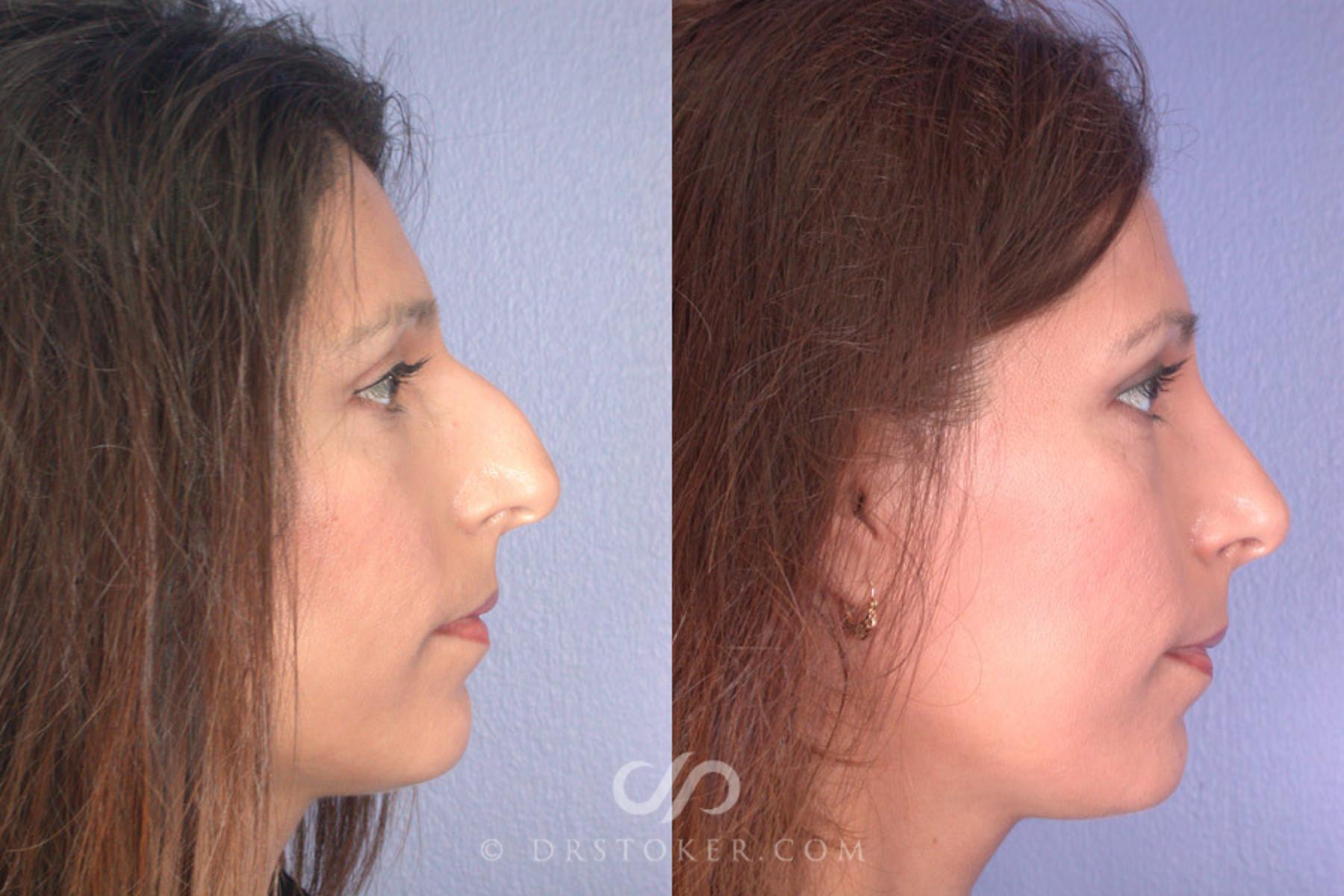 Before & After Rhinoplasty Case 273 View #4 View in Los Angeles, CA