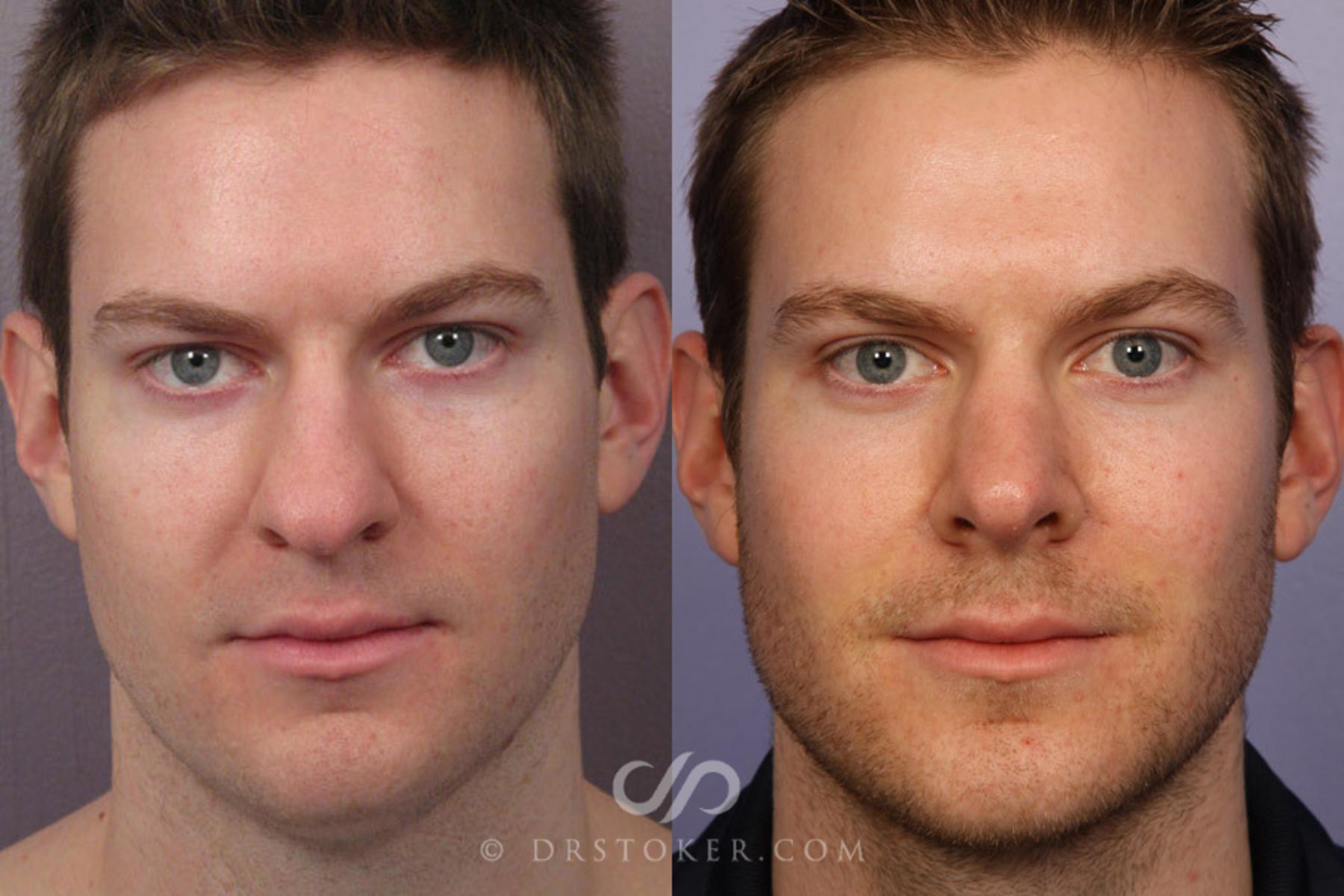 Before & After Rhinoplasty Case 274 View #1 View in Los Angeles, CA