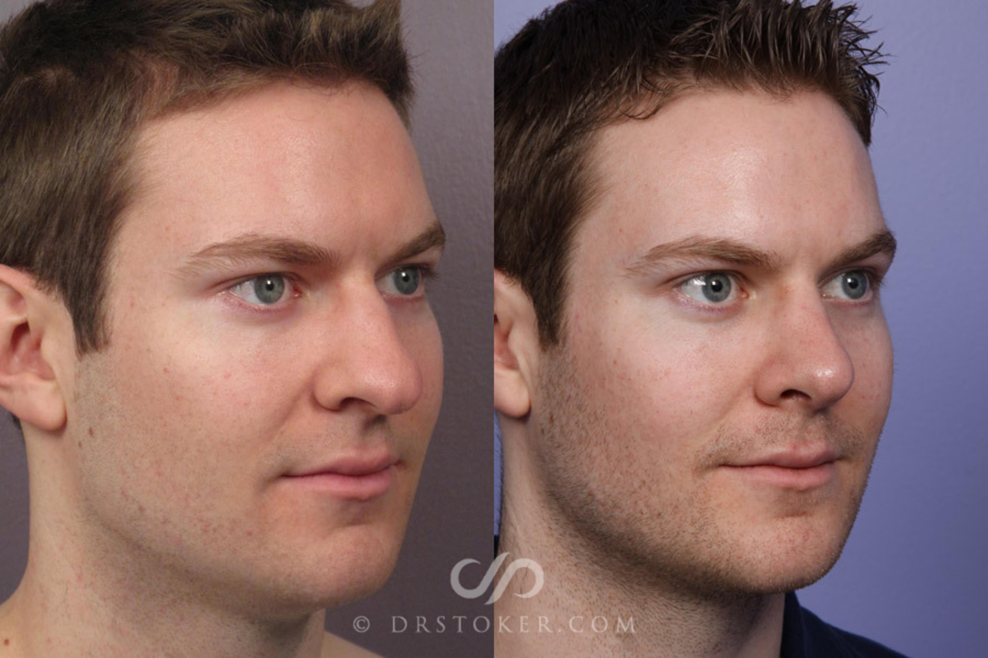 Before & After Rhinoplasty Case 274 View #2 View in Los Angeles, CA