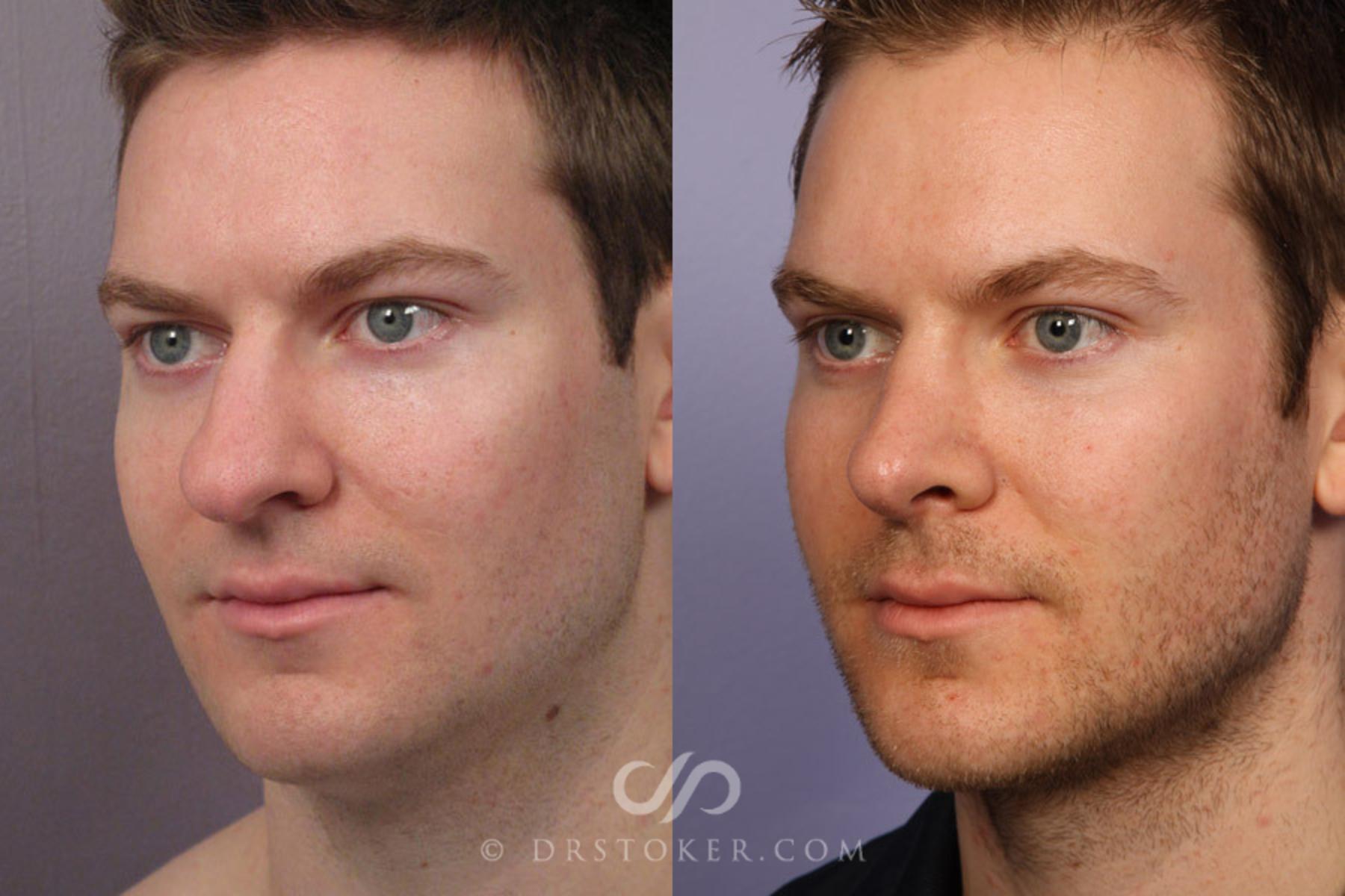 Before & After Rhinoplasty Case 274 View #3 View in Los Angeles, CA