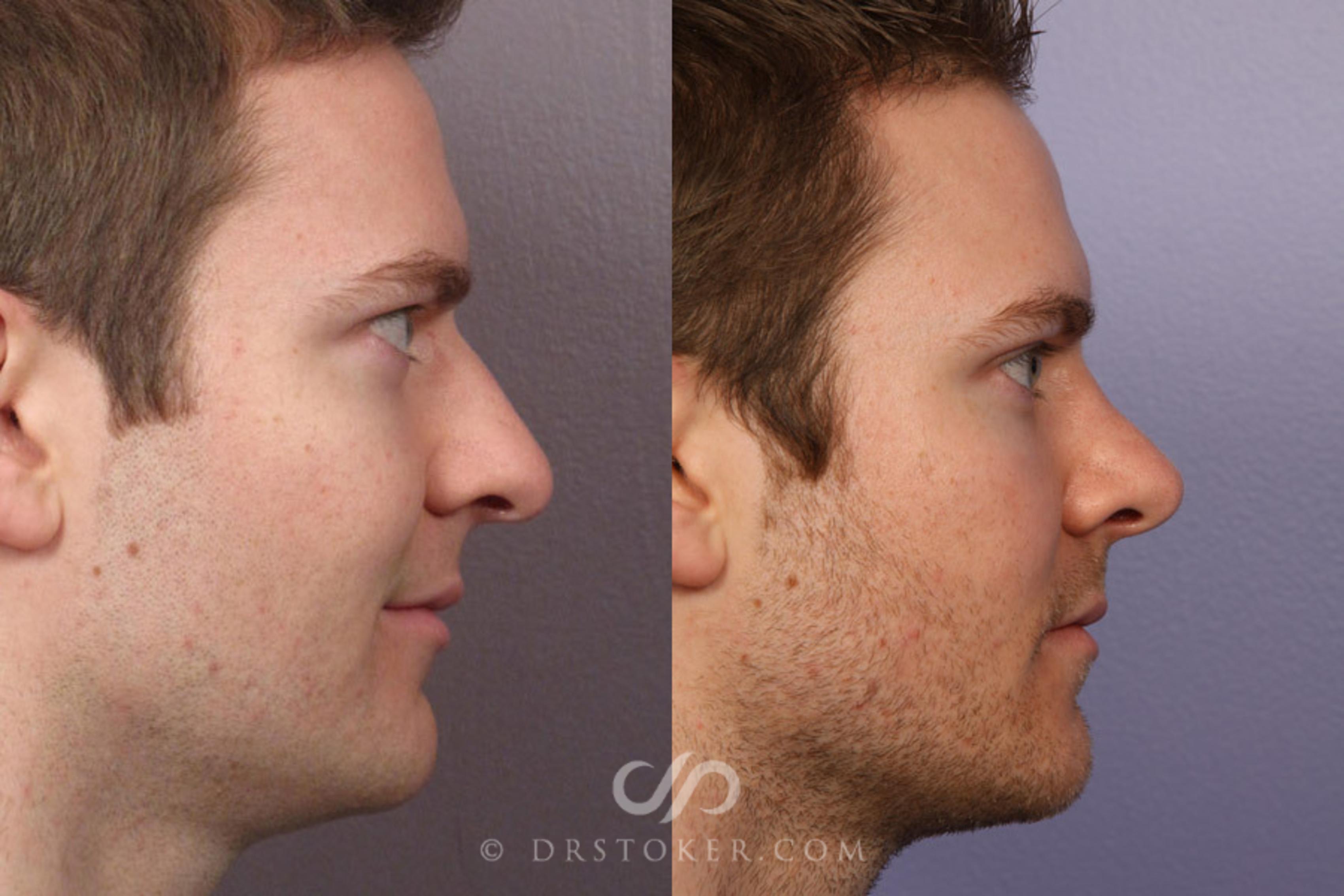 Before & After Rhinoplasty Case 274 View #4 View in Los Angeles, CA
