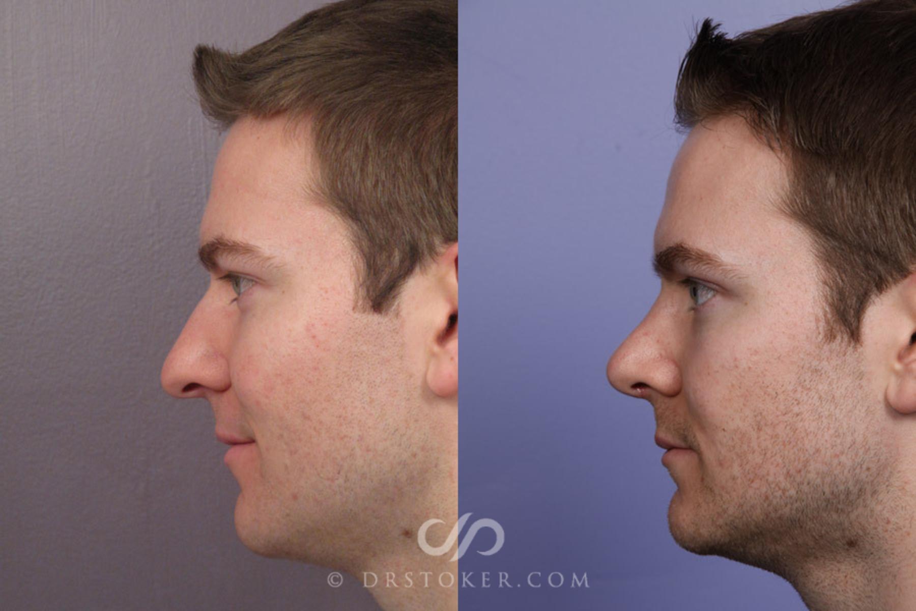Before & After Rhinoplasty Case 274 View #5 View in Los Angeles, CA