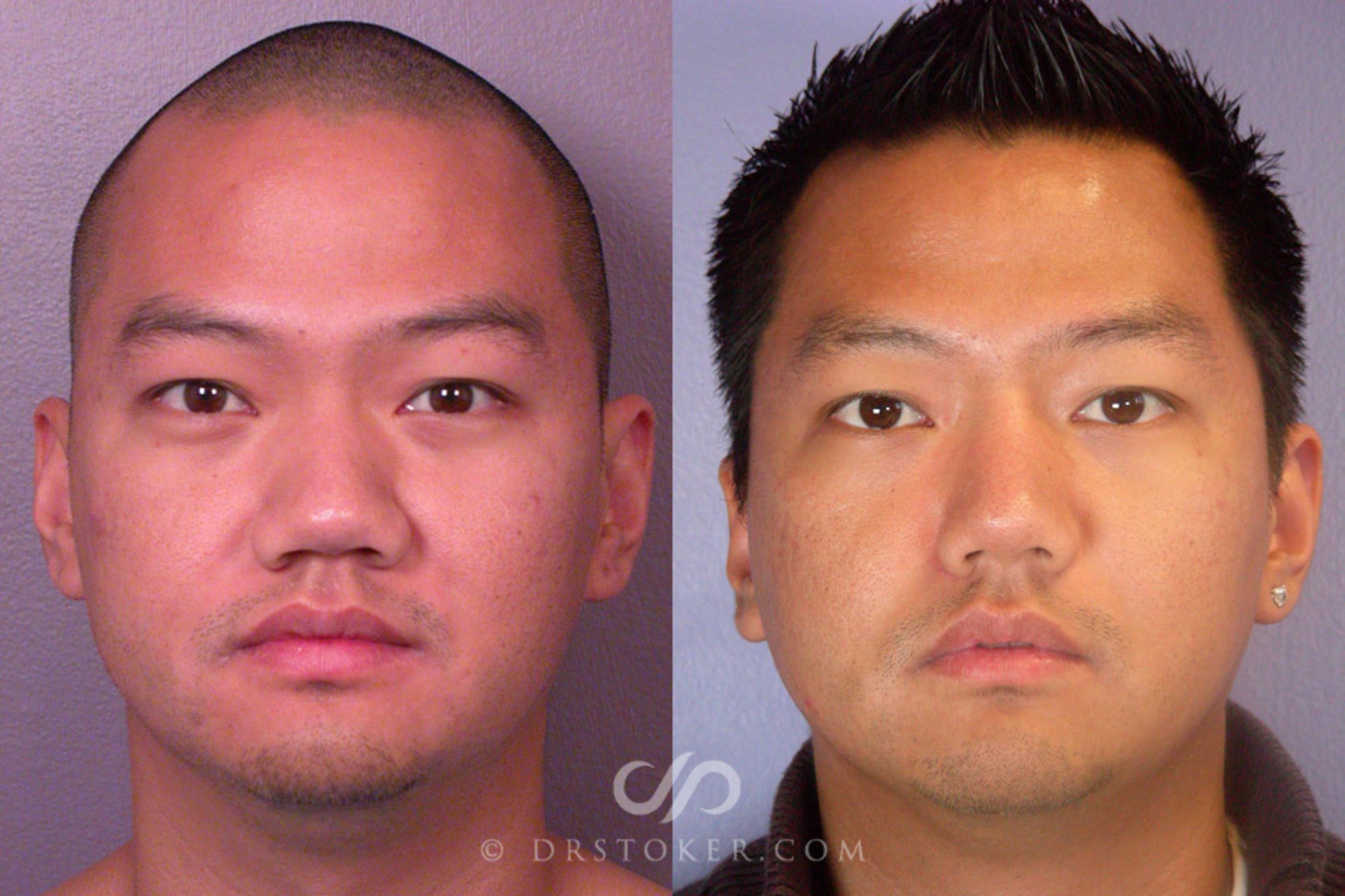 Before & After Rhinoplasty Case 275 View #1 View in Los Angeles, CA